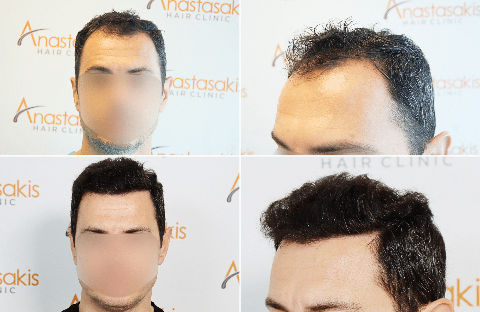 https://www.anastasakishairclinic.gr/portfolio/apotelesma-metamosxefsis-mallion-anastasakis-hair-clinic-191/