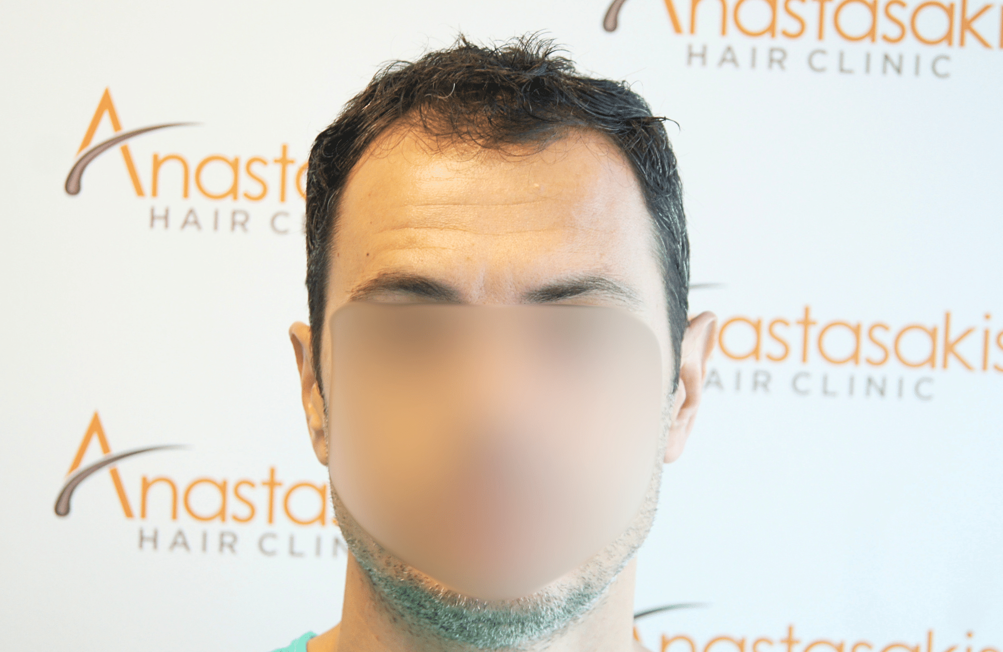 hair transplant 2200 fus stage 3 thick