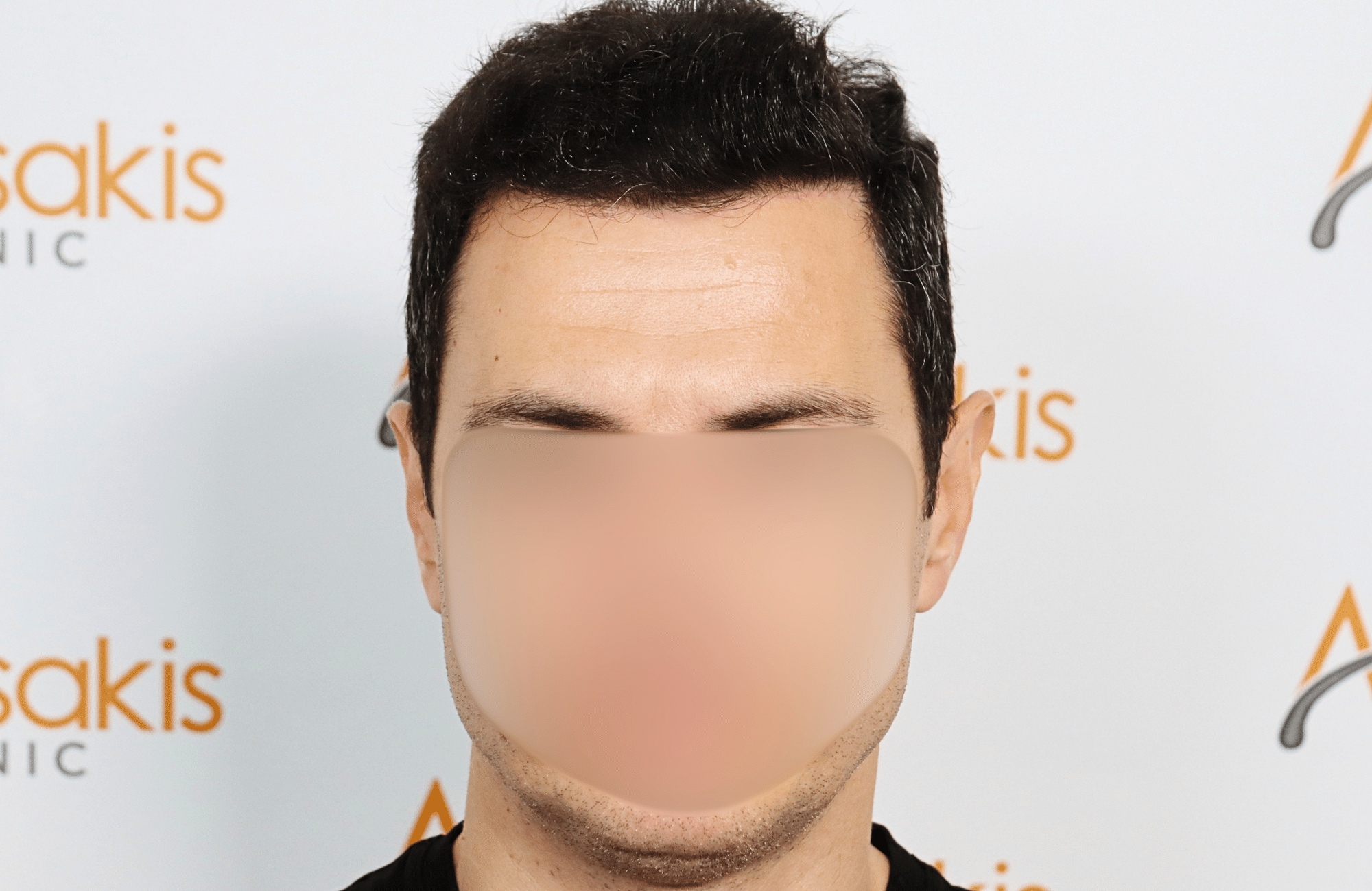 hair transplant 2200 fus stage 3 thick