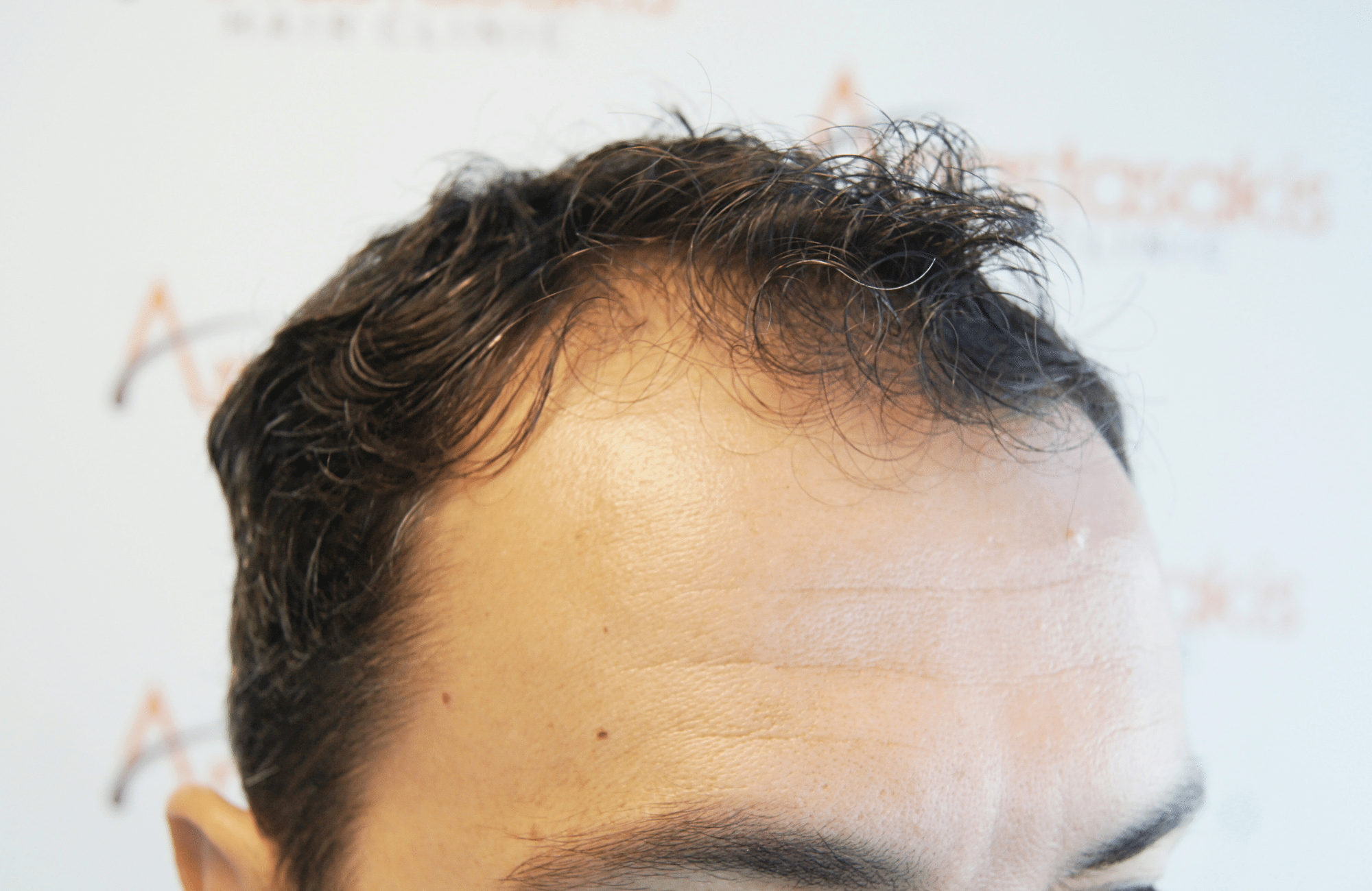 hair transplant 2200 fus stage 3 thick