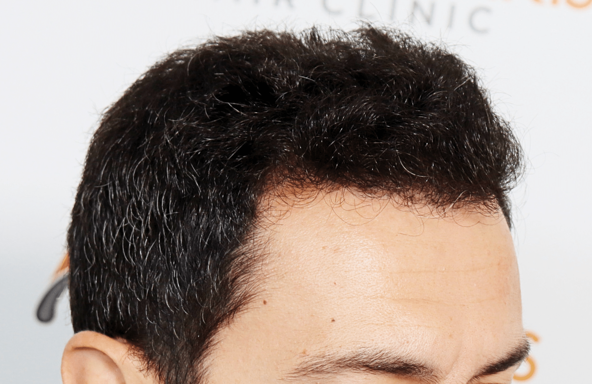 hair transplant 2200 fus stage 3 thick