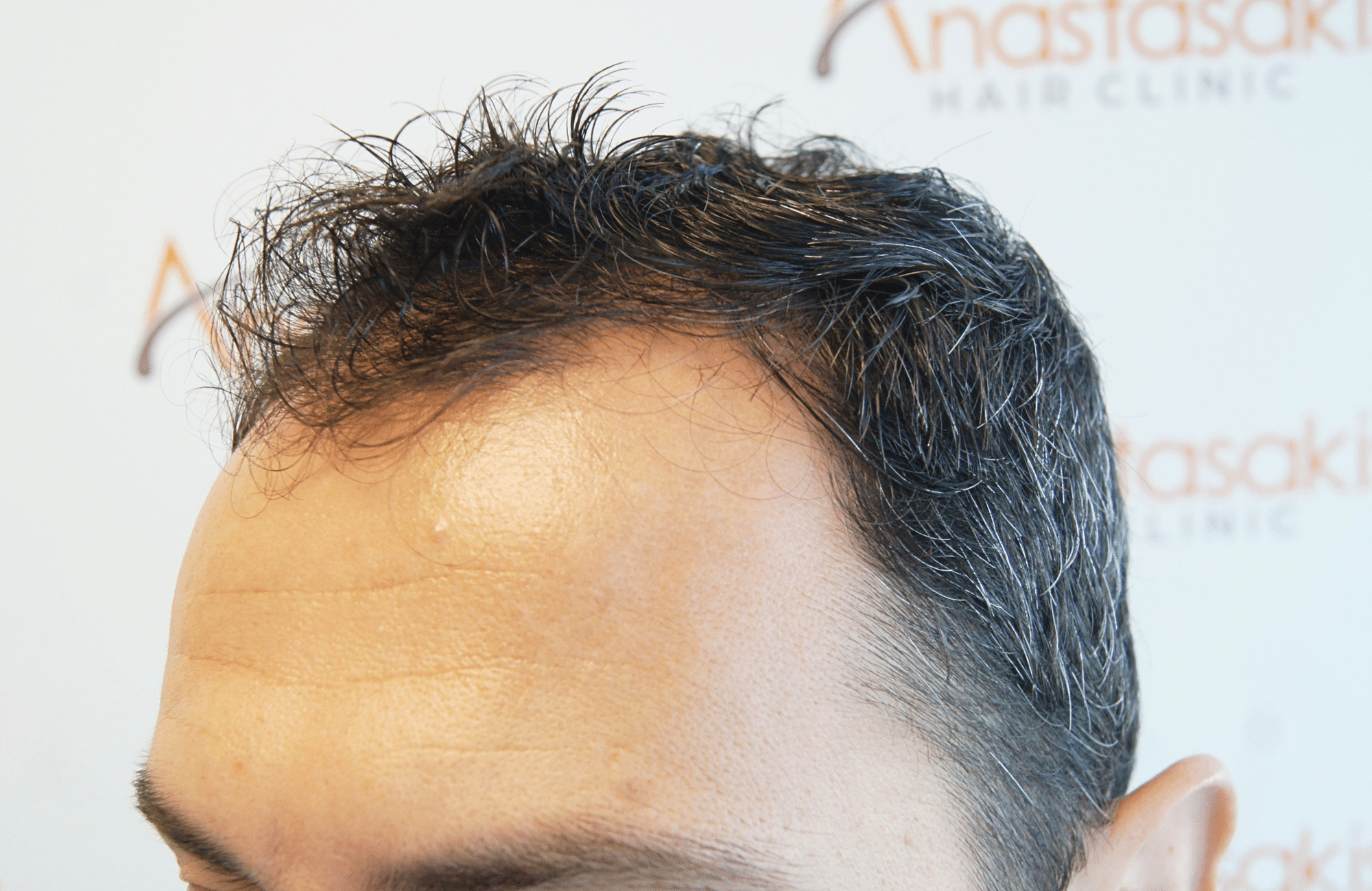 hair transplant 2200 fus stage 3 thick