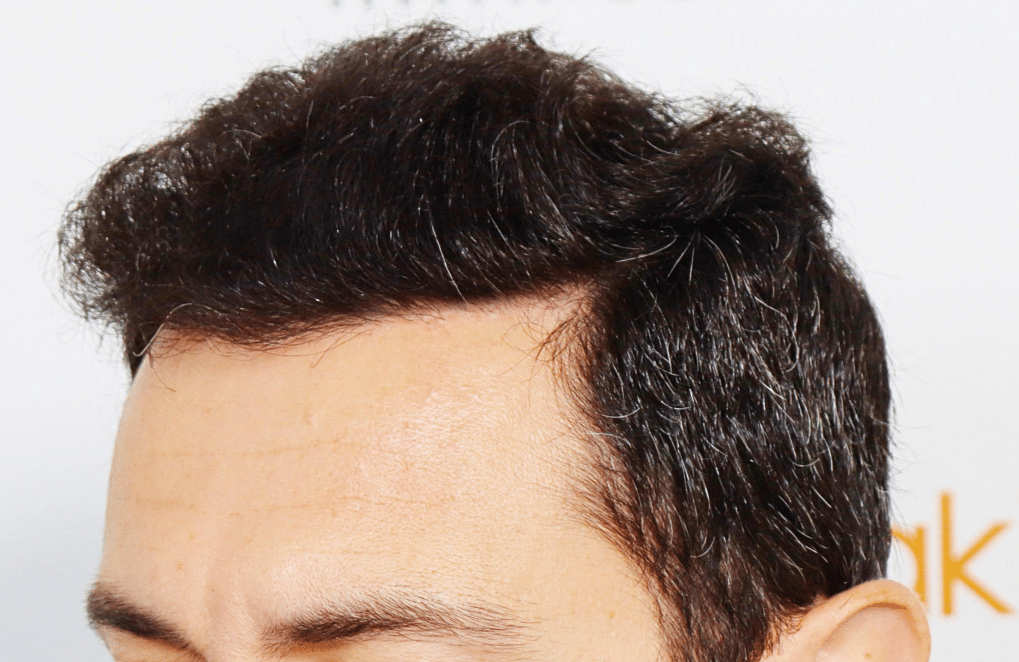 hair transplant 2200 fus stage 3 thick