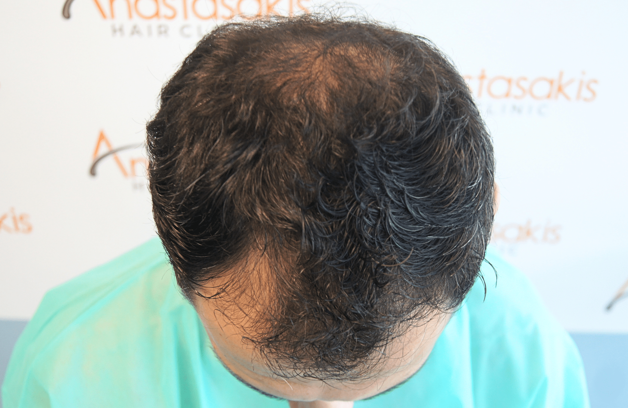 hair transplant 2200 fus stage 3 thick