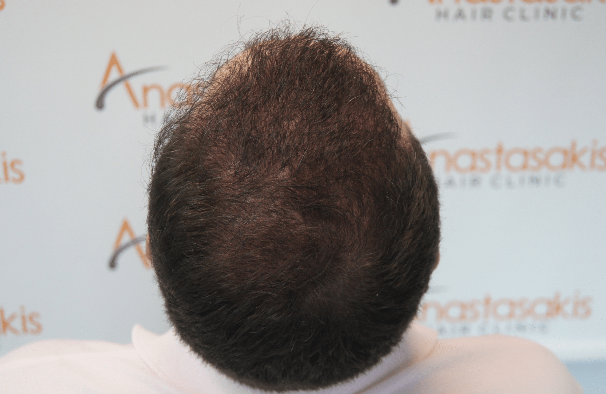 hair transplant patient result with 3500 fus after - back
