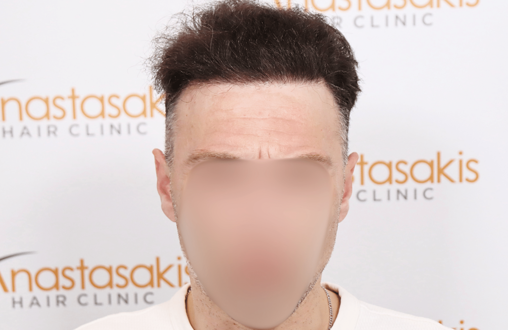 hair transplant resilt 2500 fus wavy frontal thick