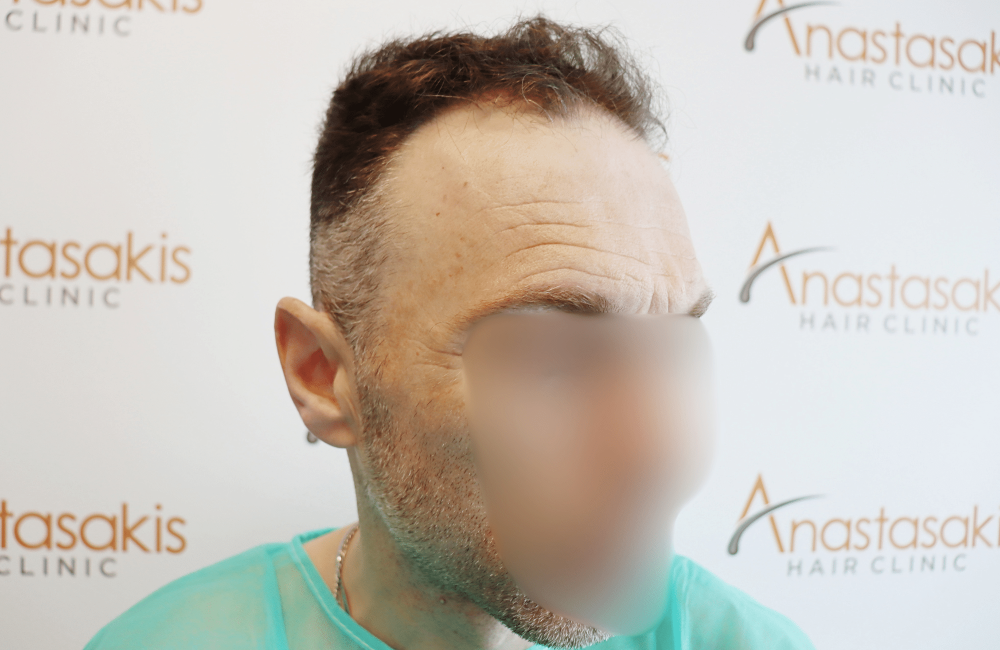 hair transplant resilt 2500 fus wavy frontal thick