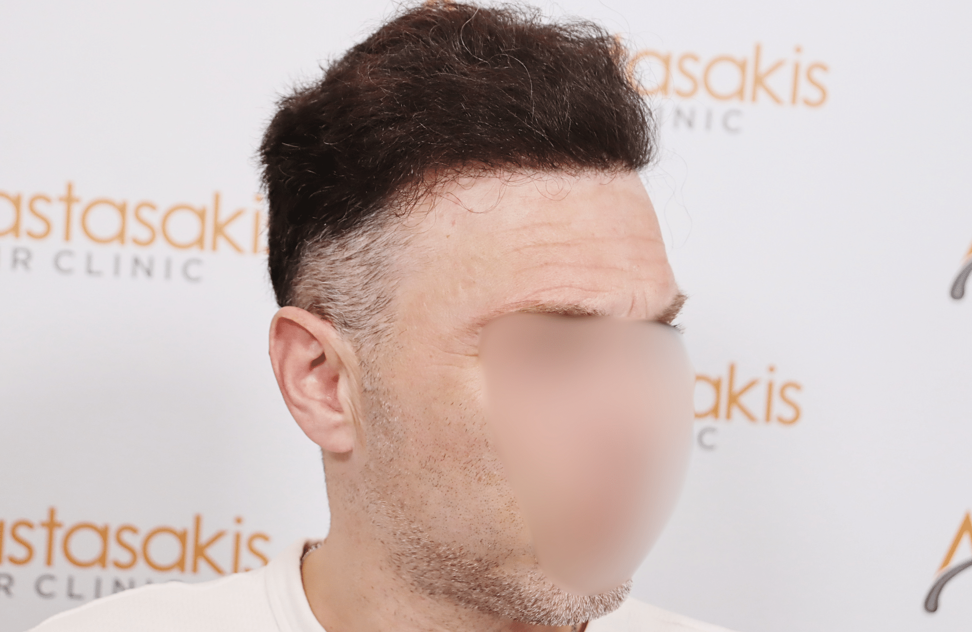 hair transplant resilt 2500 fus wavy frontal thick