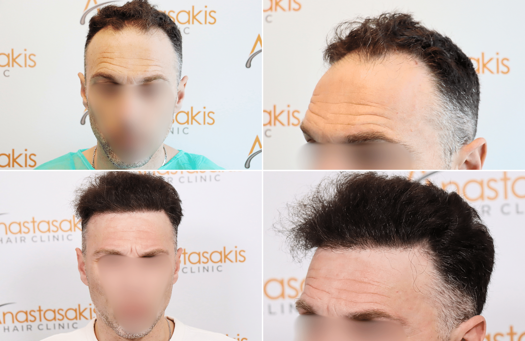https://www.anastasakishairclinic.gr/portfolio/apotelesma-metamosxefsis-mallion-anastasakis-hair-clinic-206/