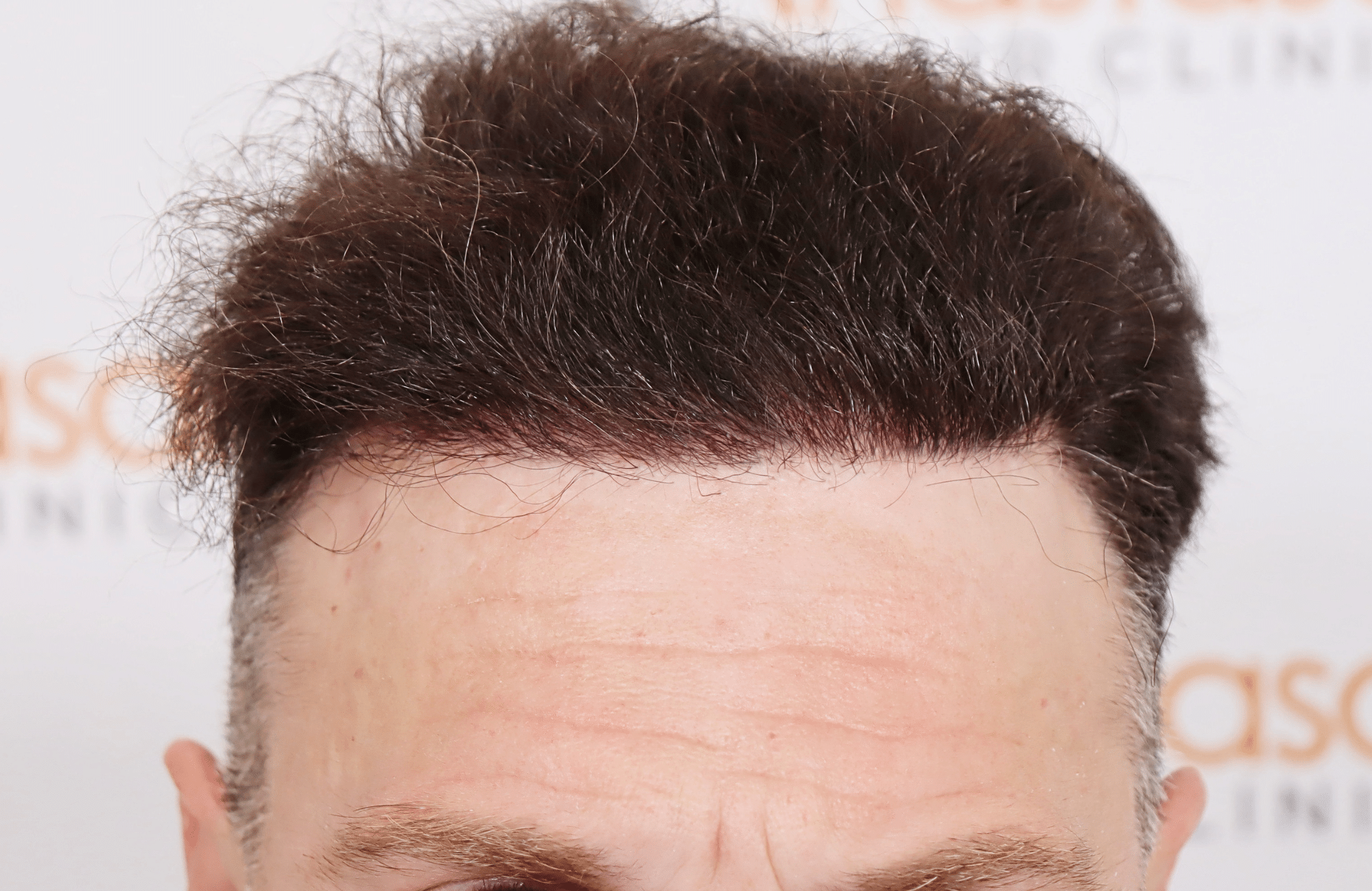 hair transplant resilt 2500 fus wavy frontal thick