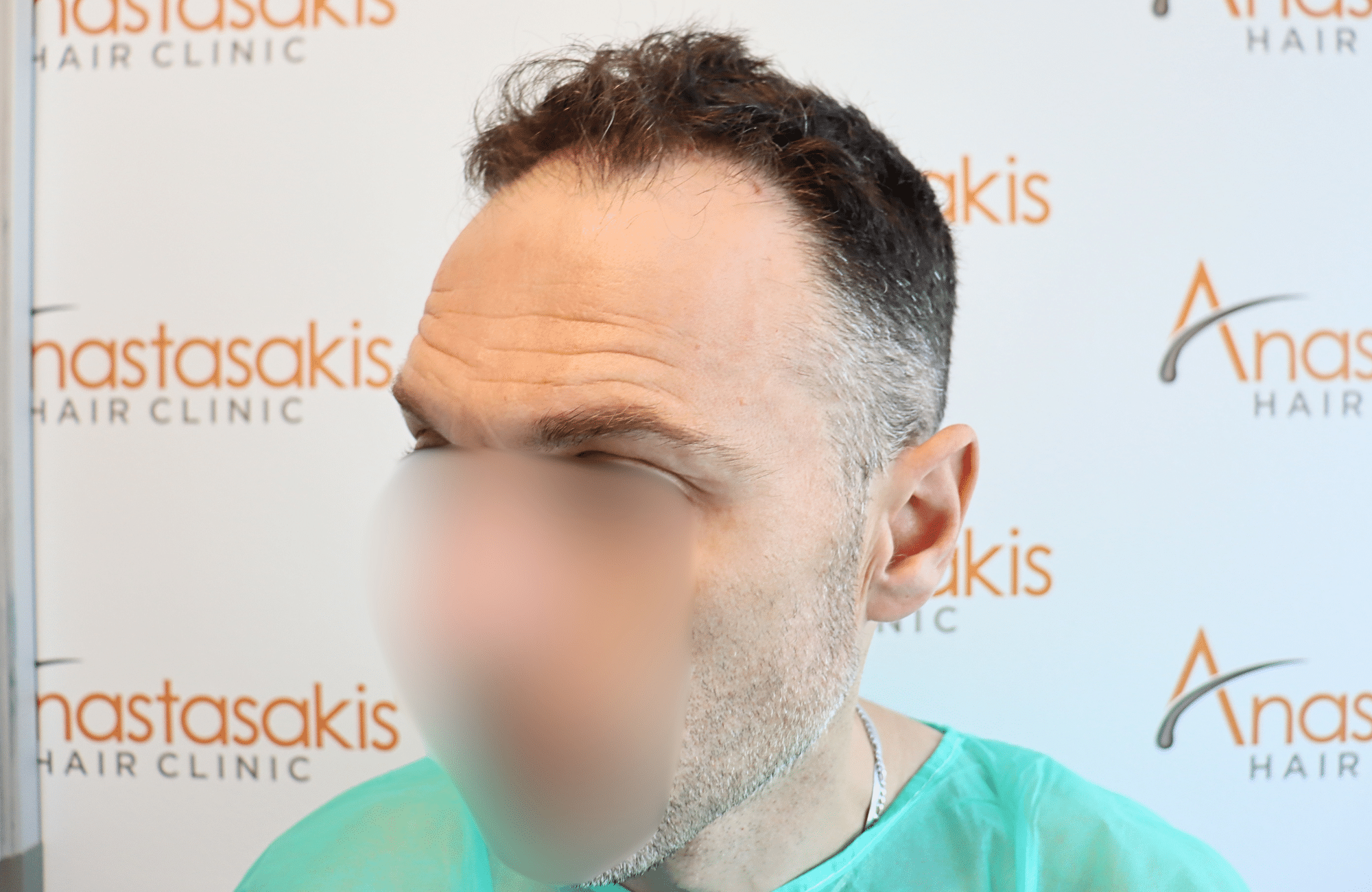 hair transplant resilt 2500 fus wavy frontal thick