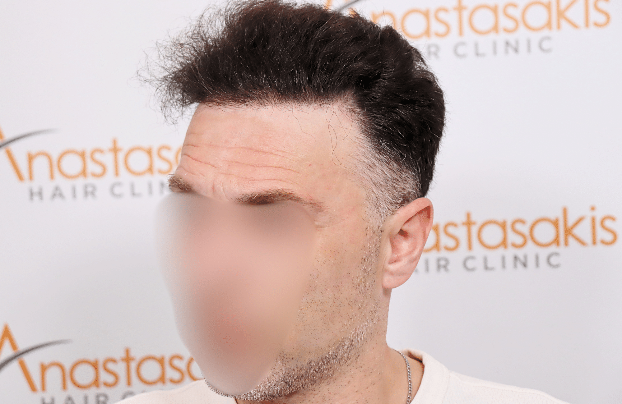 hair transplant resilt 2500 fus wavy frontal thick