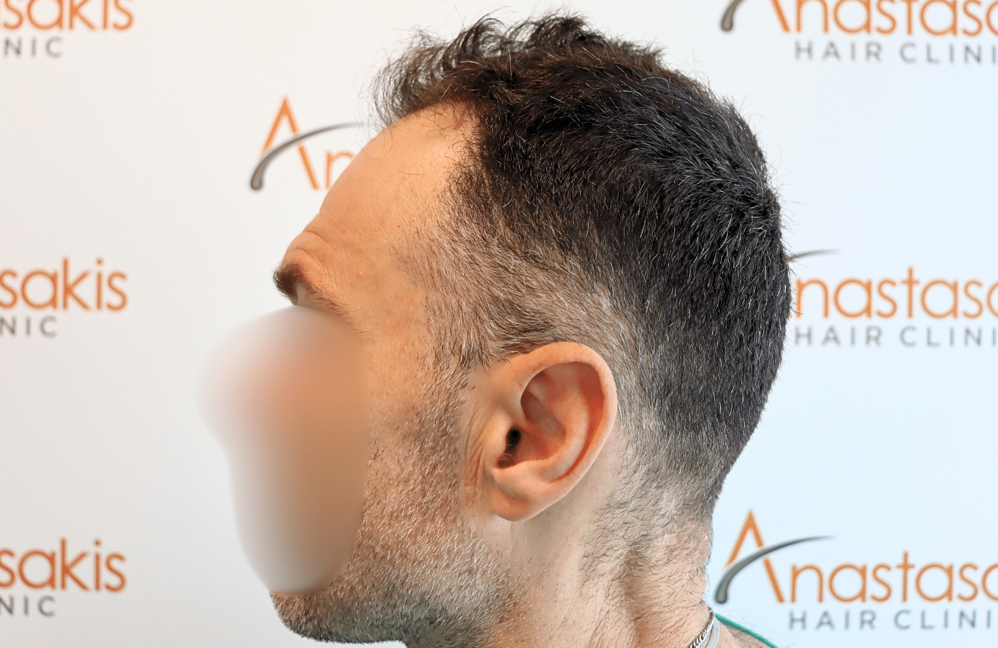 hair transplant resilt 2500 fus wavy frontal thick