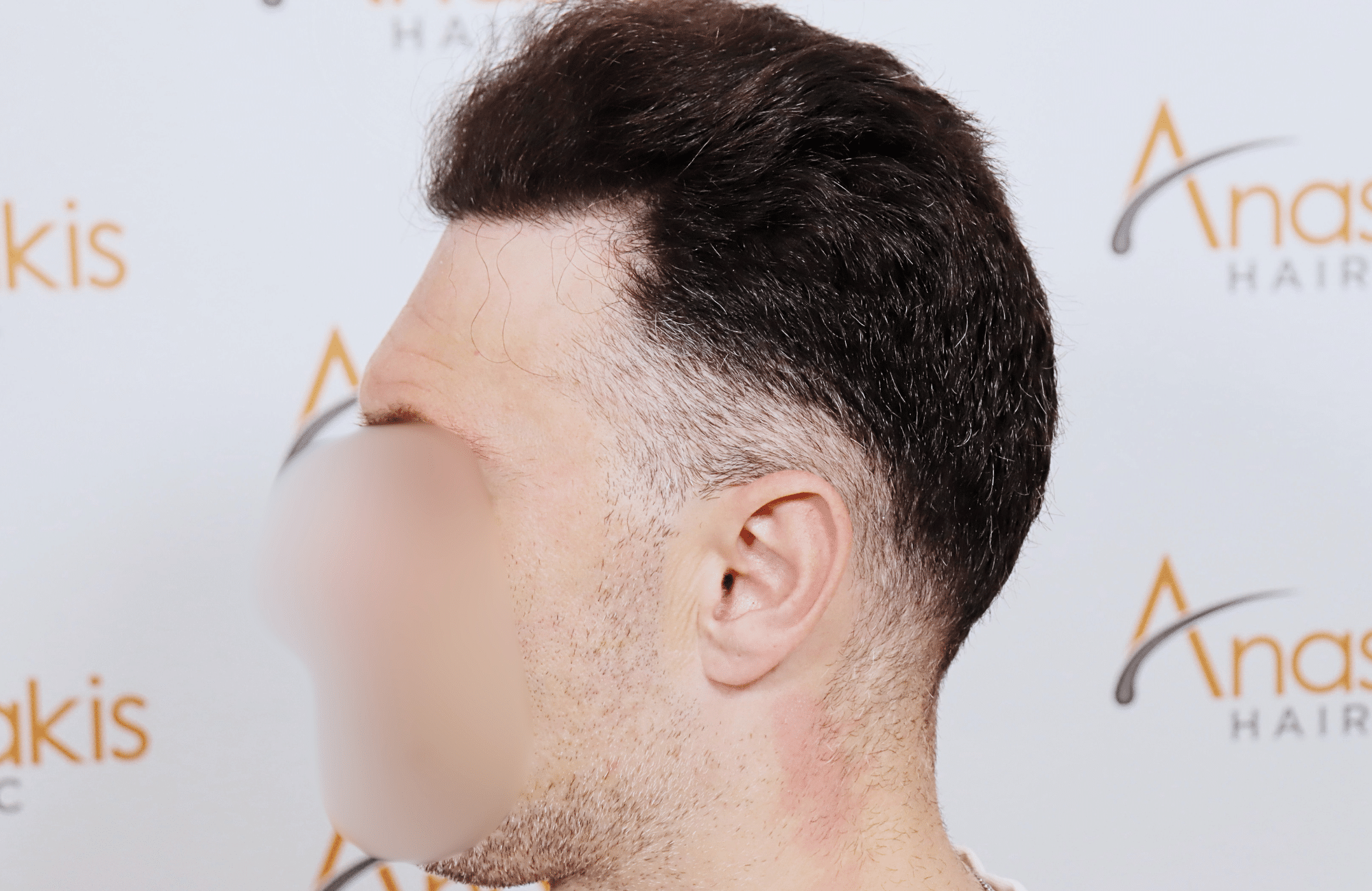 hair transplant resilt 2500 fus wavy frontal thick