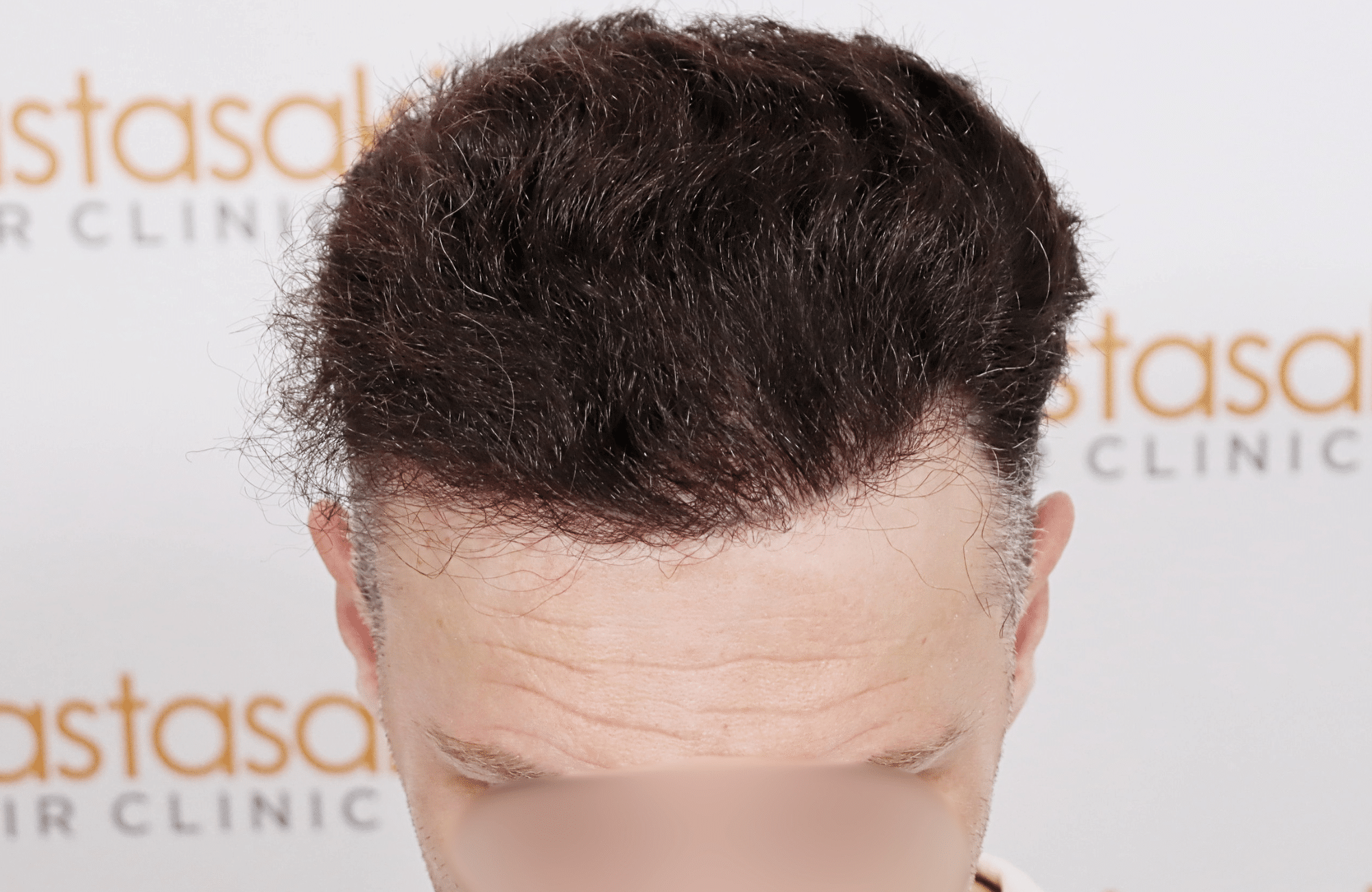 hair transplant resilt 2500 fus wavy frontal thick