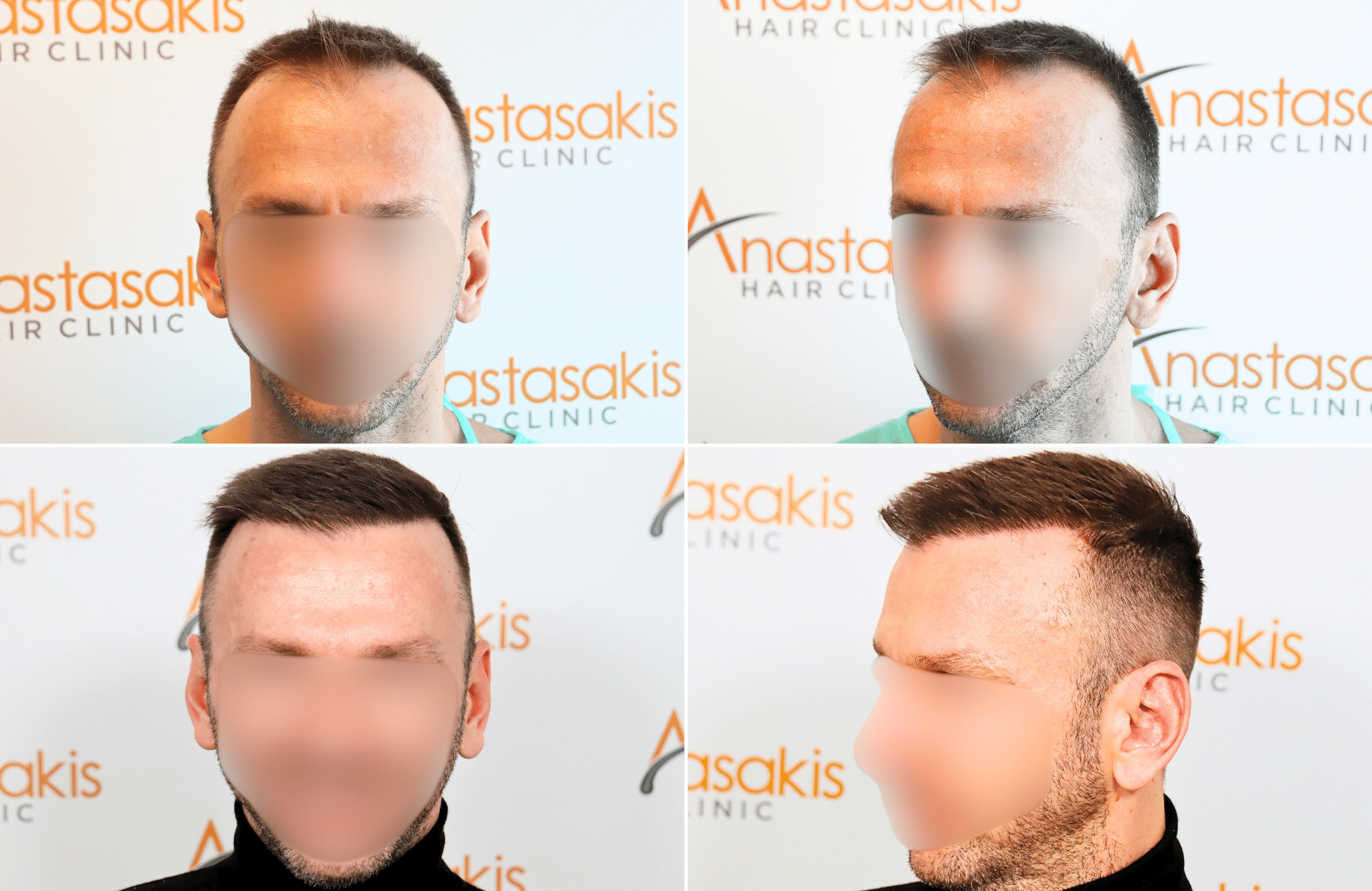 https://www.anastasakishairclinic.gr/portfolio/apotelesma-metamosxefsis-mallion-anastasakis-hair-clinic-207/