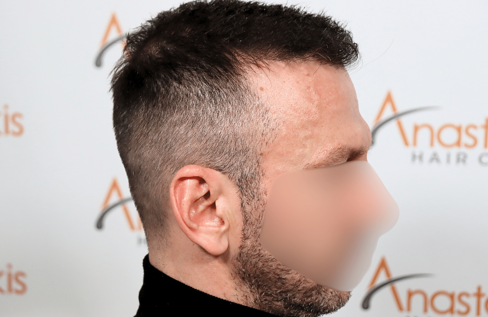 hair transplant resukt with 2600 fus triangular