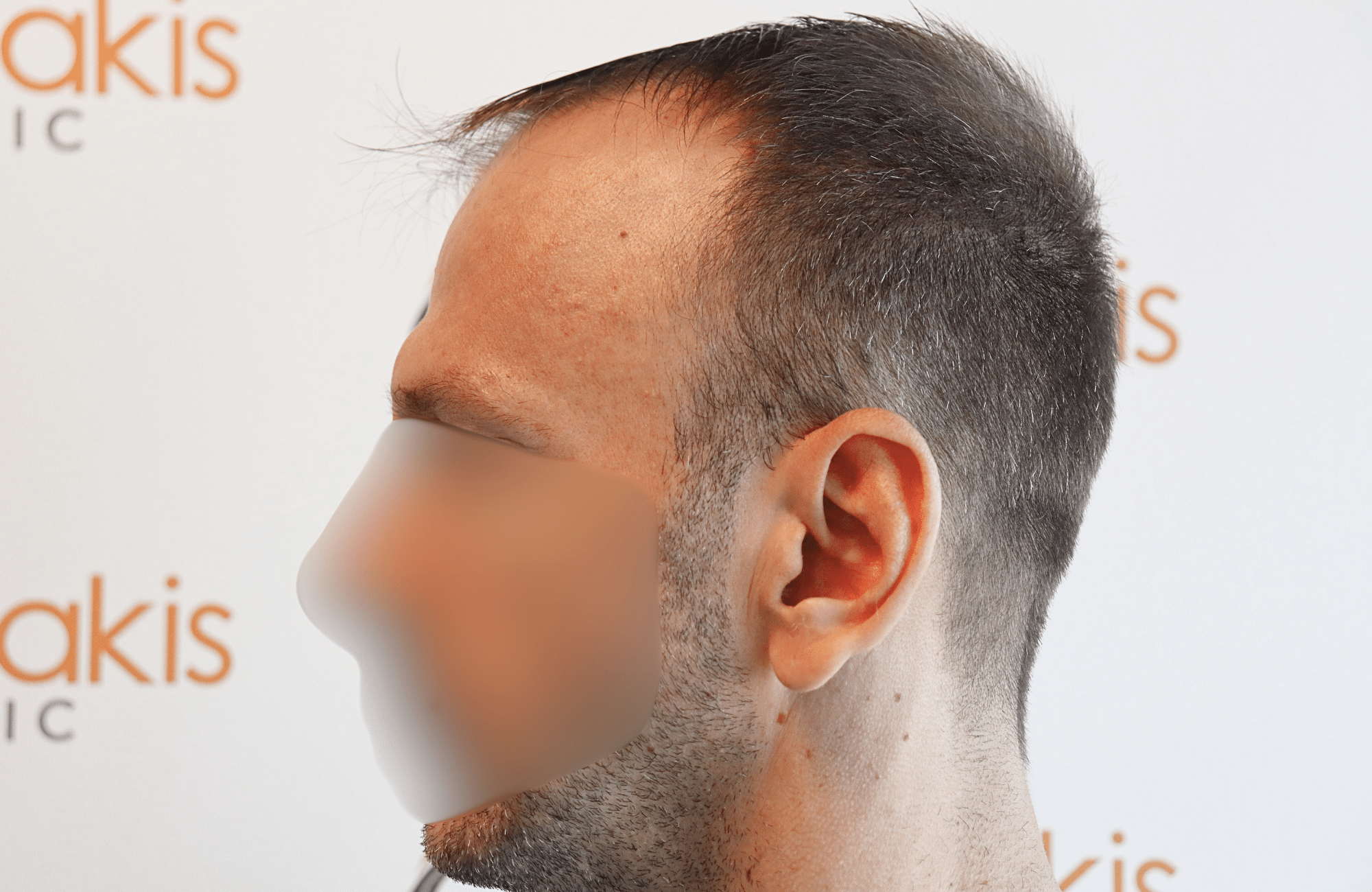 hair transplant resukt with 2600 fus triangular