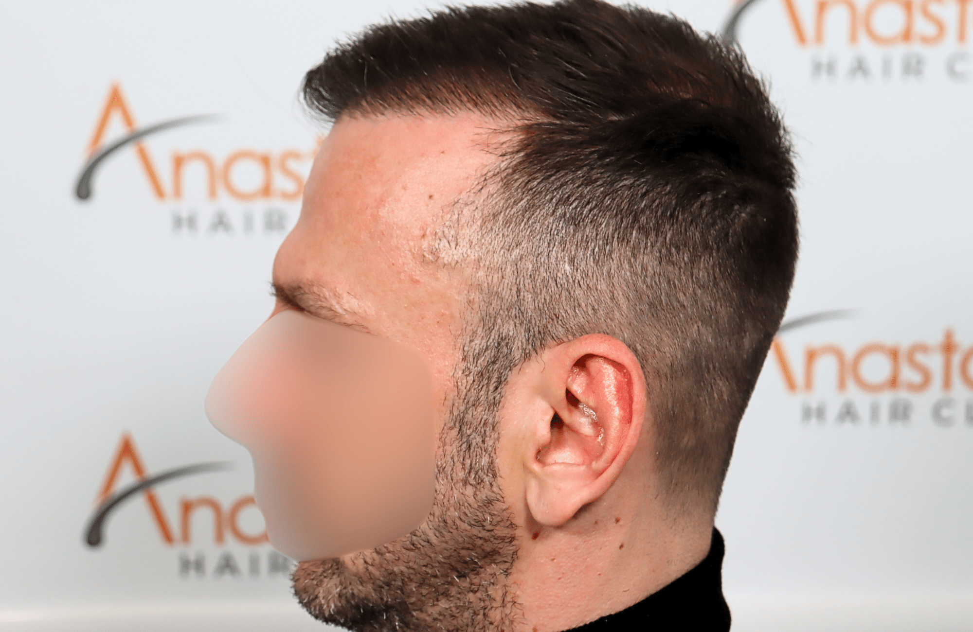 hair transplant resukt with 2600 fus triangular