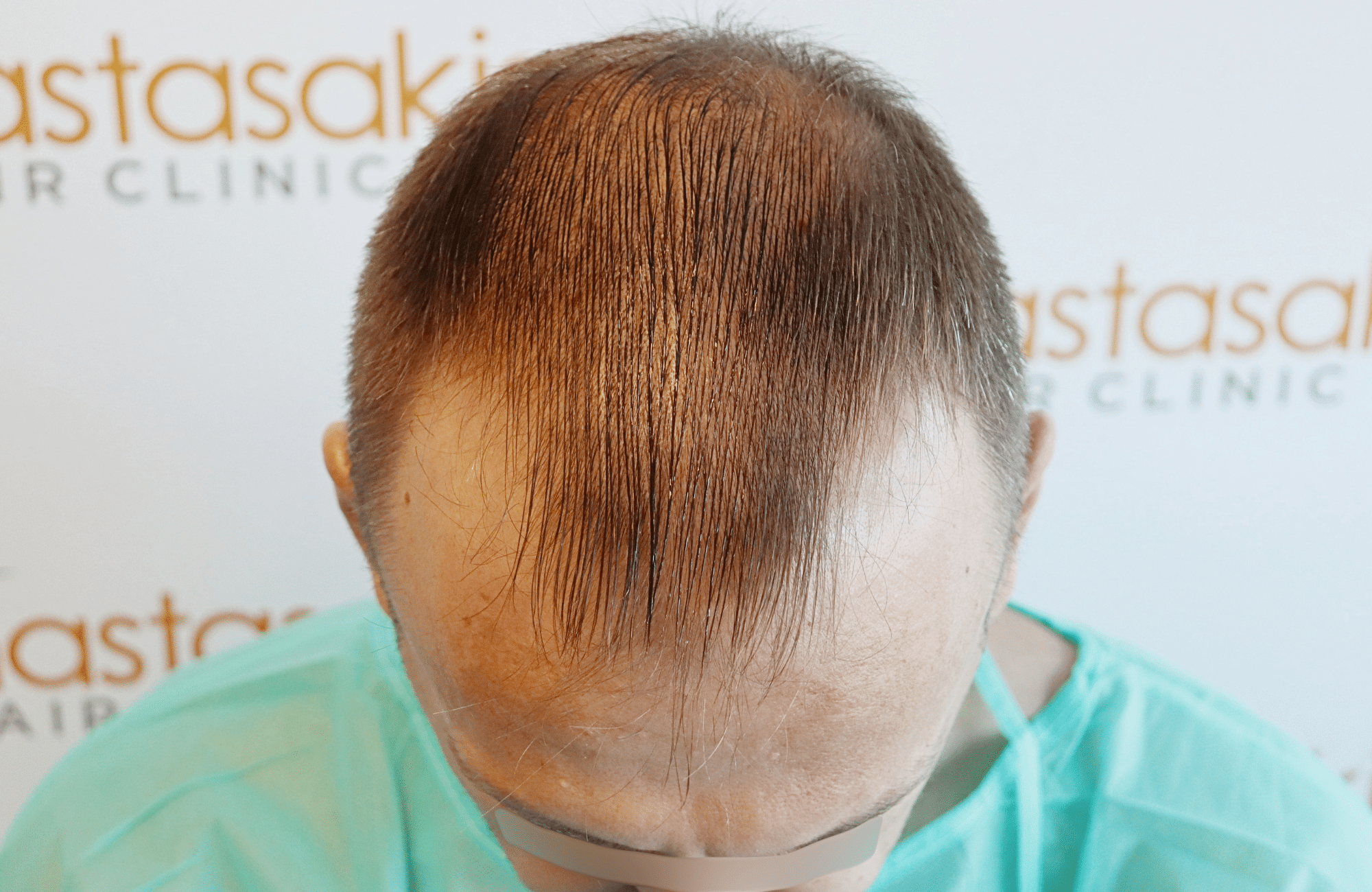 hair transplant resukt with 2600 fus triangular