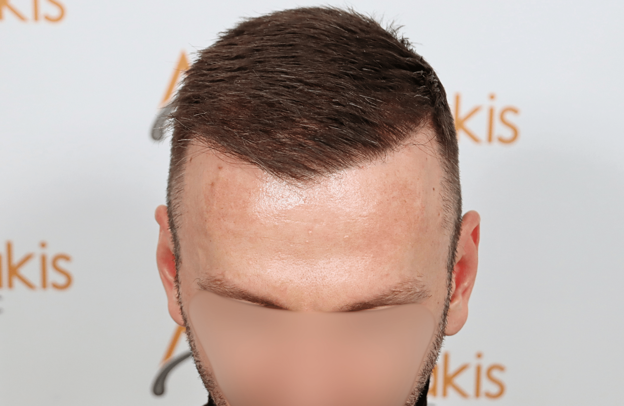 hair transplant resukt with 2600 fus triangular