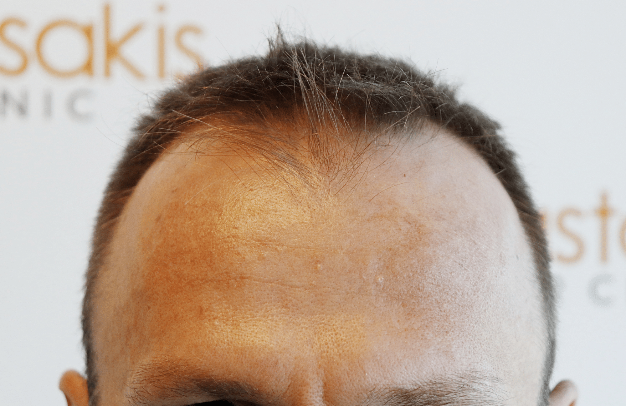 hair transplant resukt with 2600 fus triangular