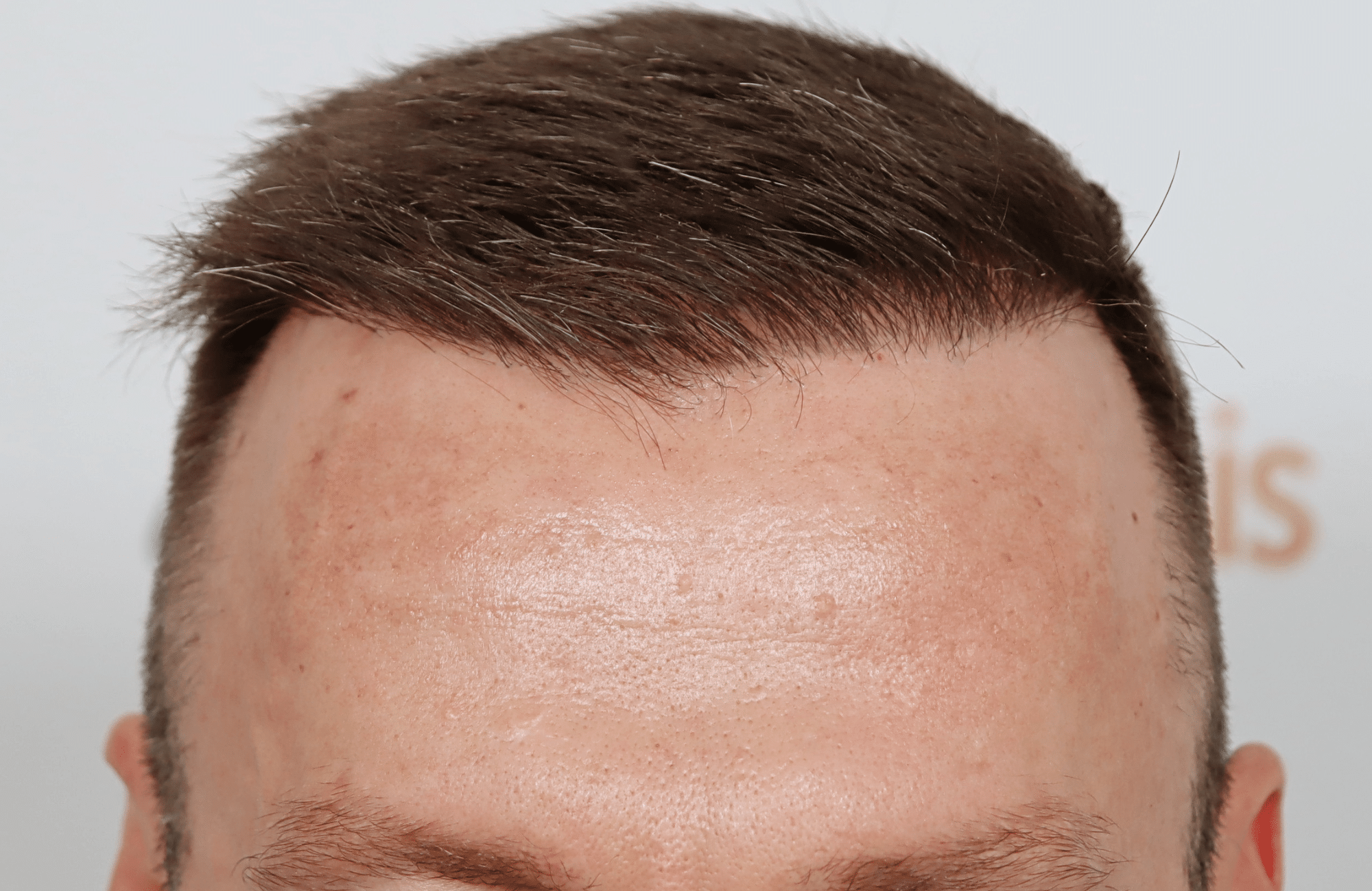hair transplant resukt with 2600 fus triangular