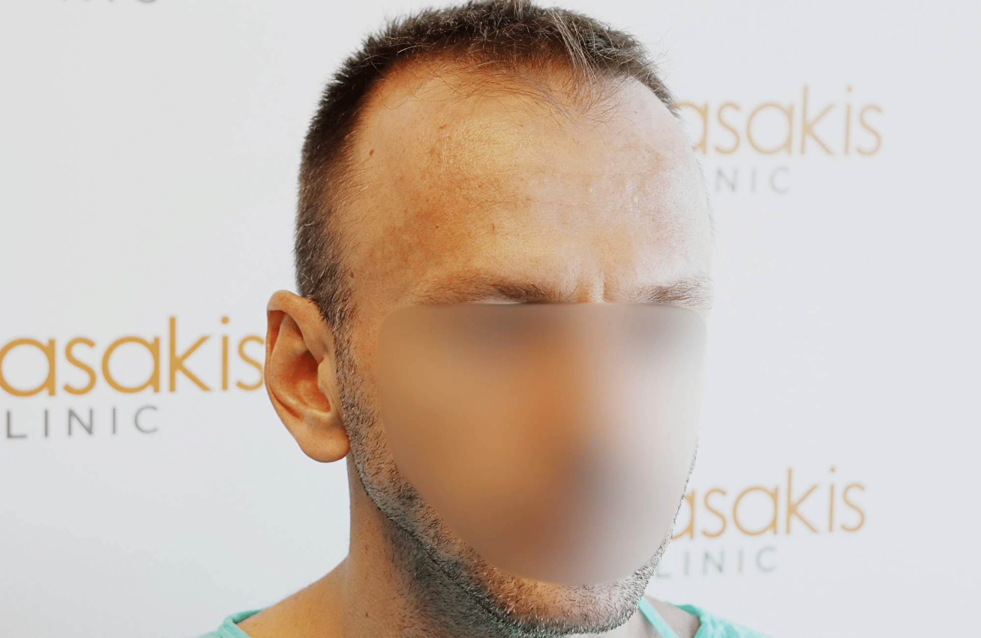 hair transplant resukt with 2600 fus triangular
