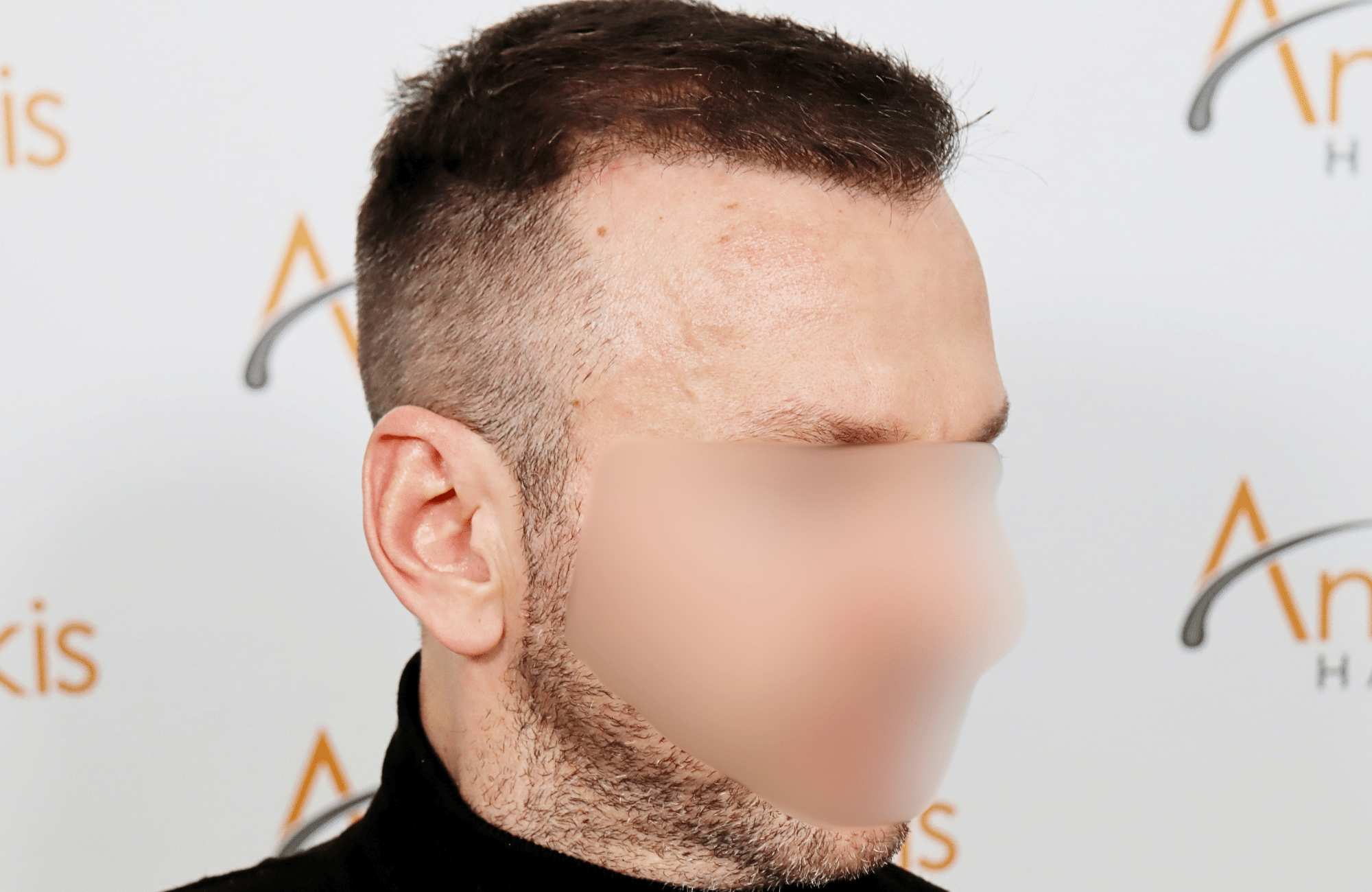 hair transplant resukt with 2600 fus triangular