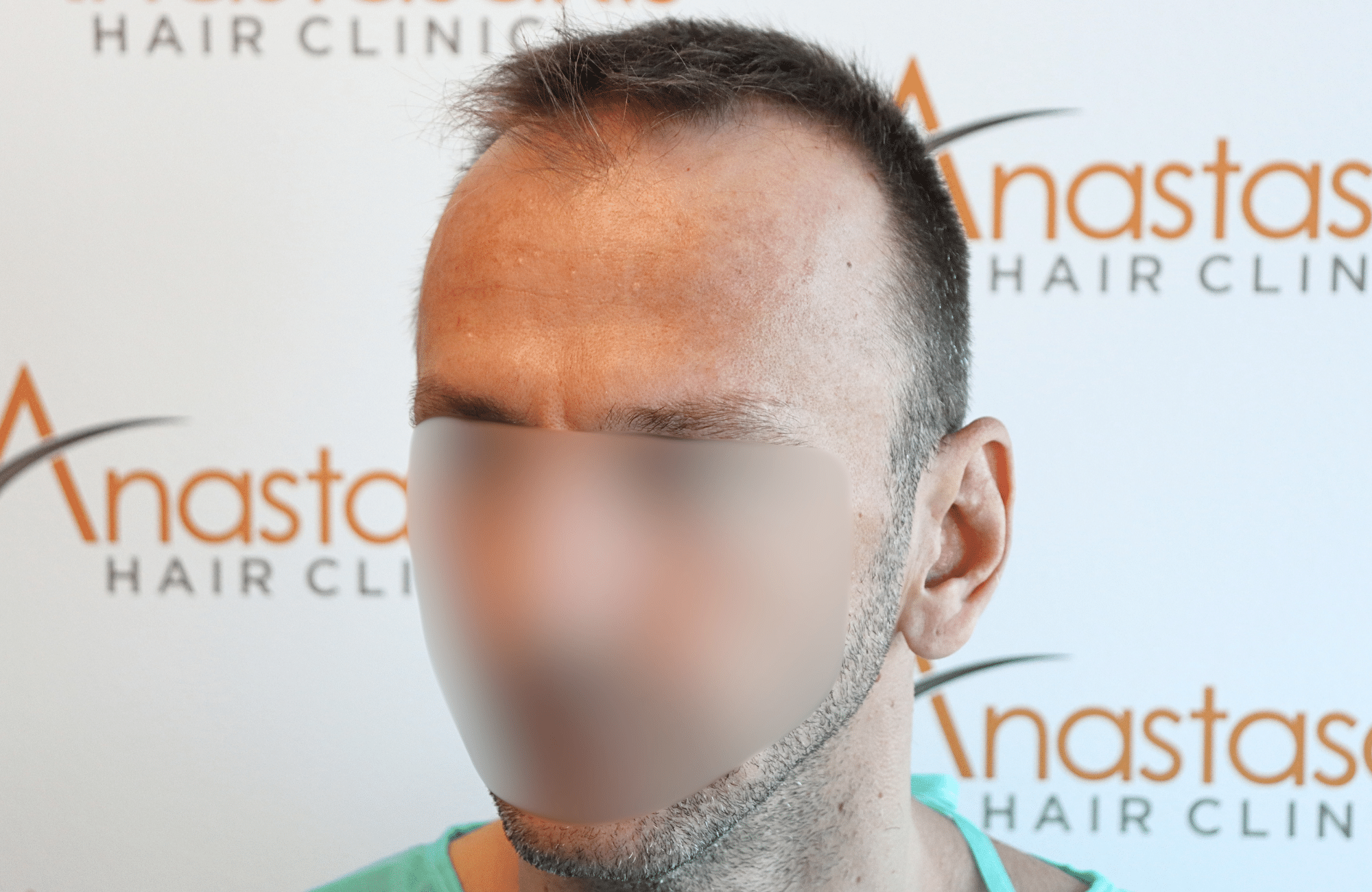 hair transplant resukt with 2600 fus triangular