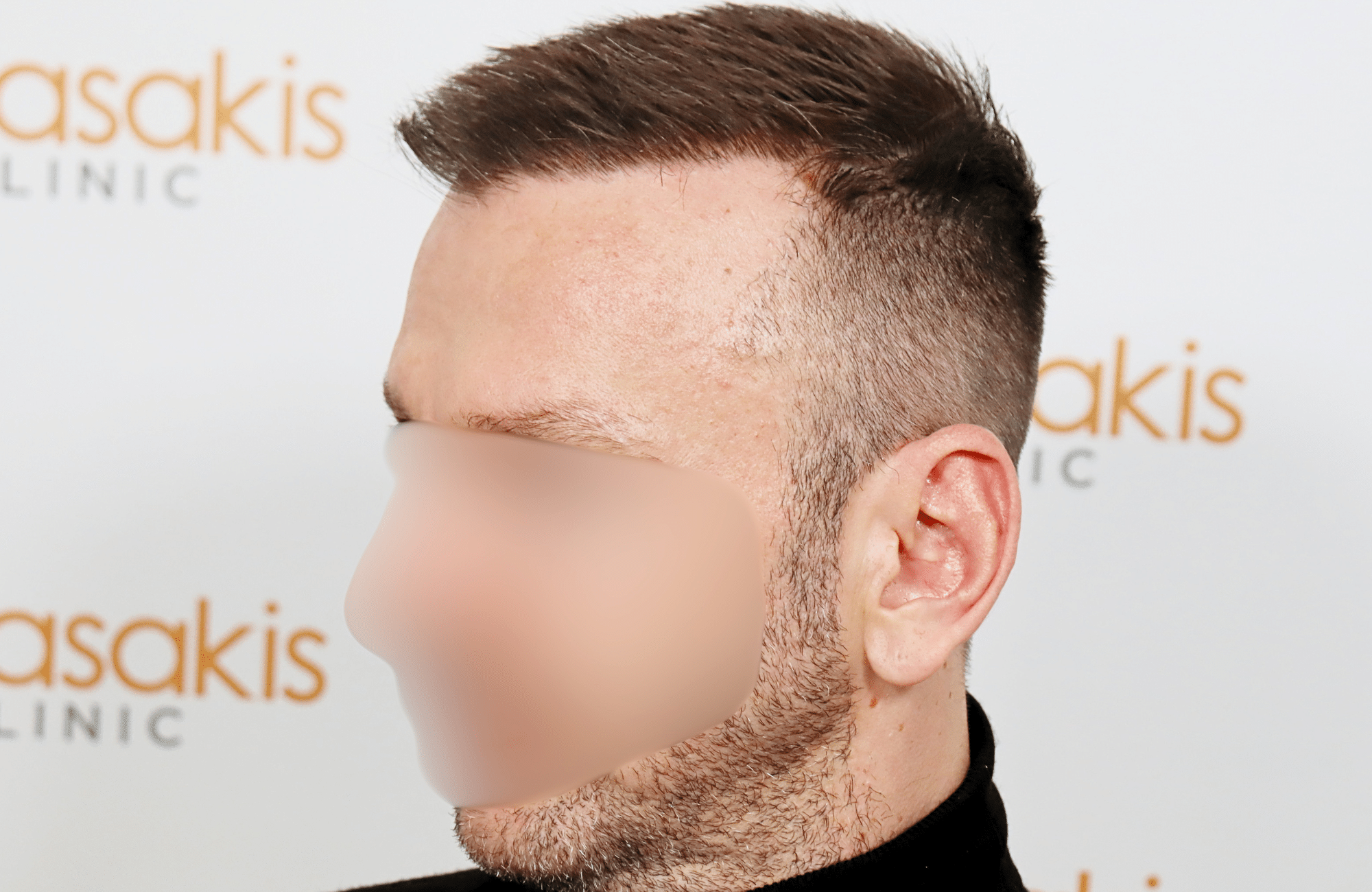 hair transplant resukt with 2600 fus triangular