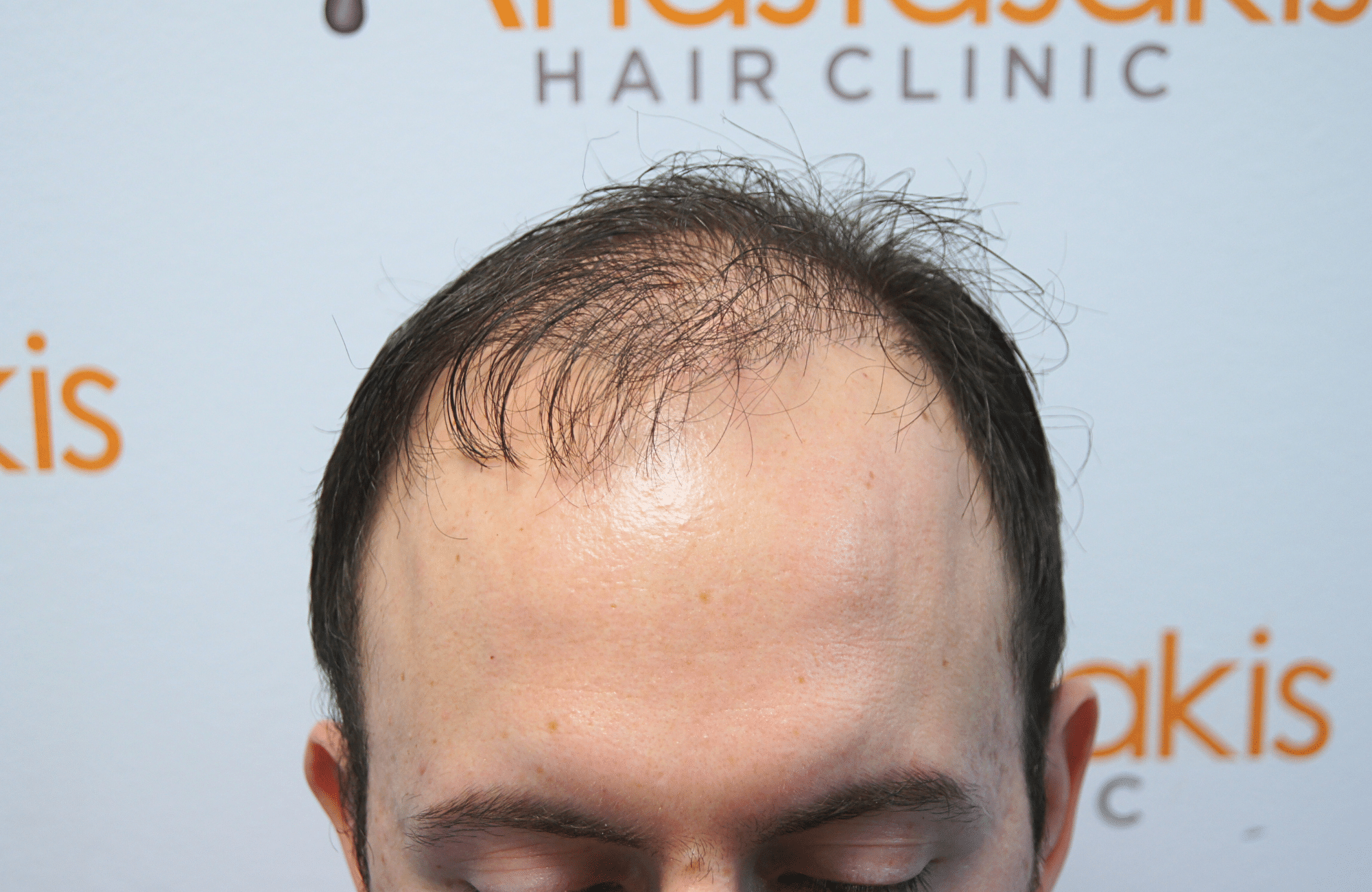 hair transplant result