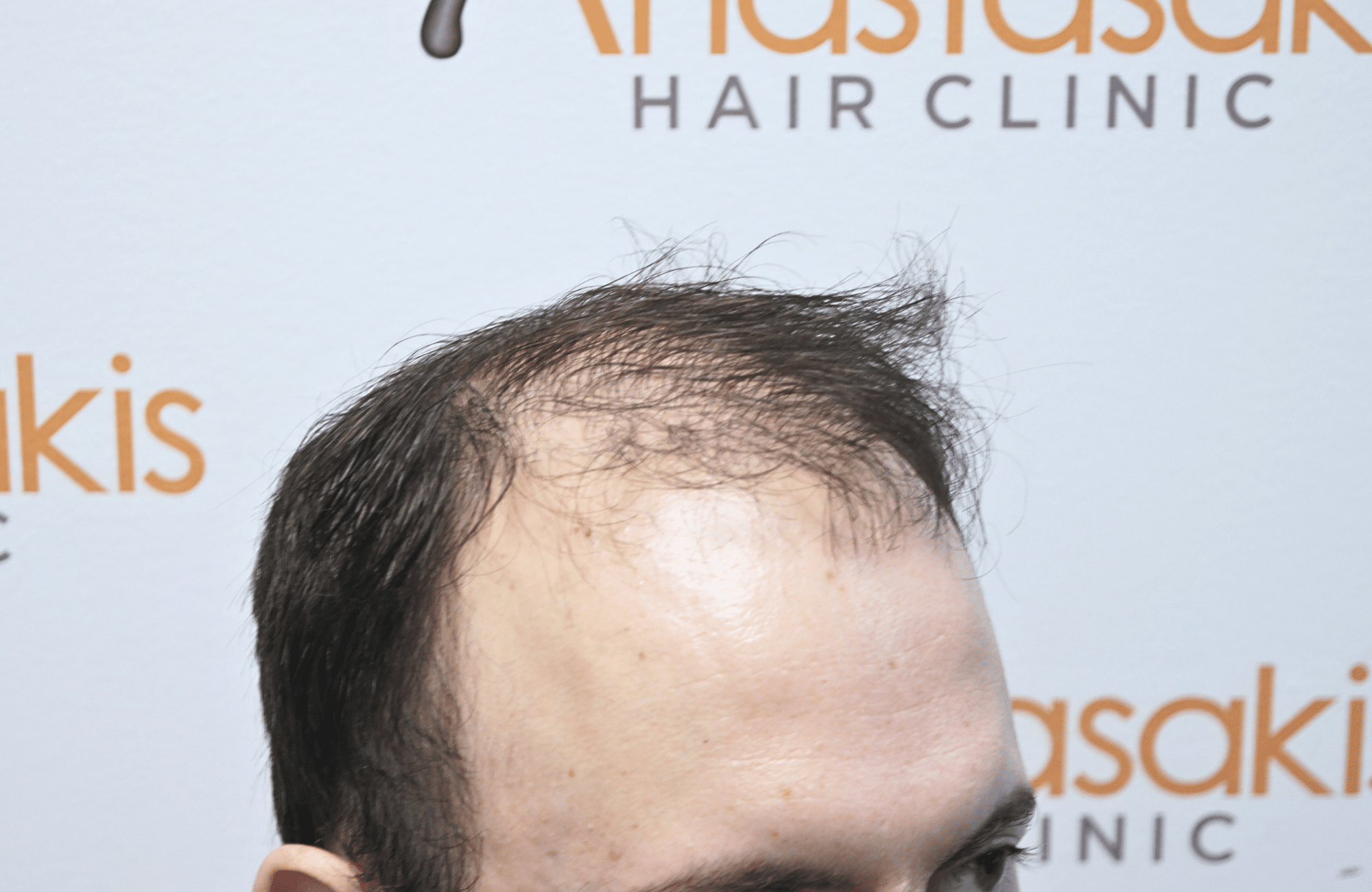 hair transplant result