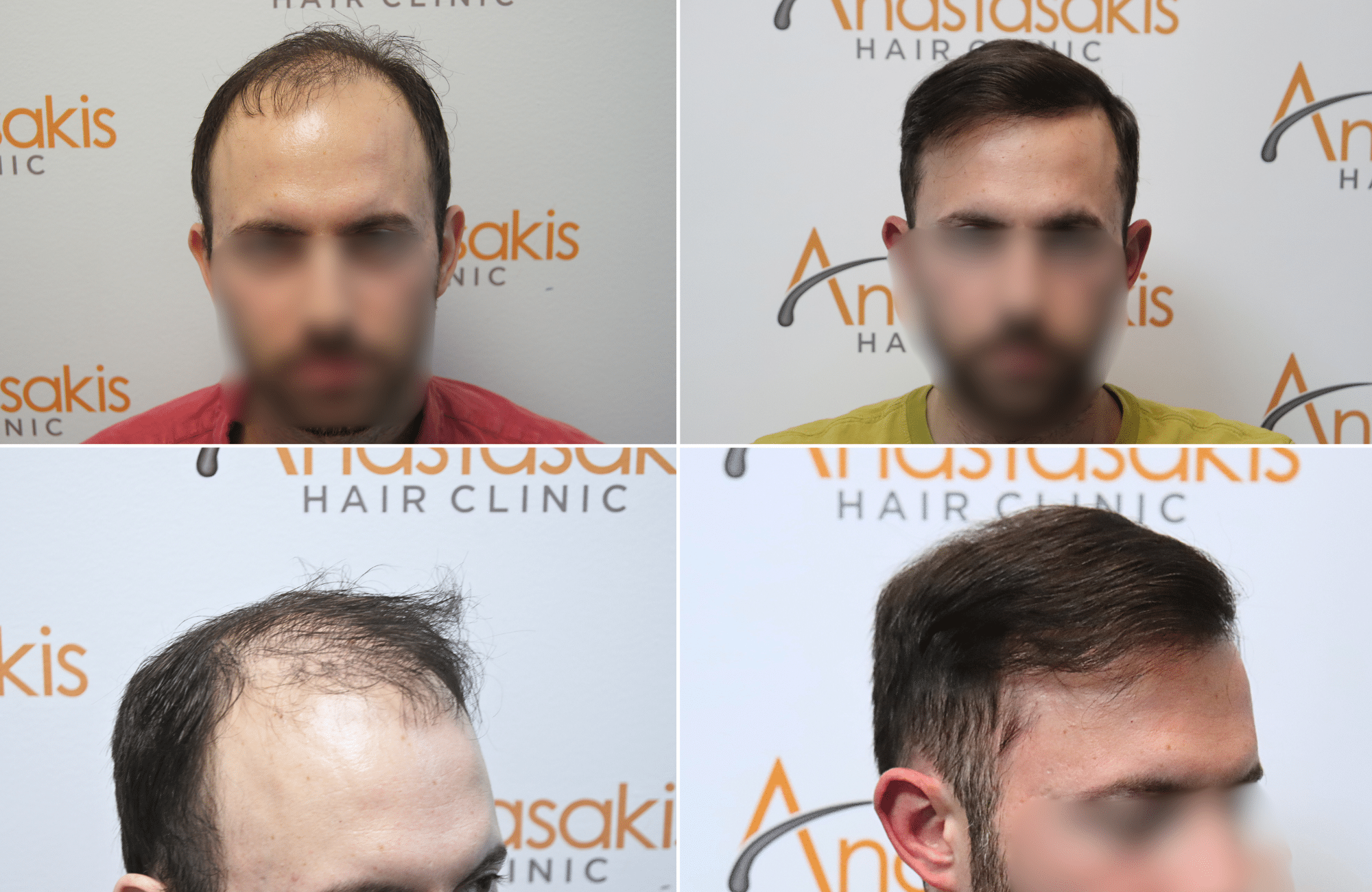 https://www.anastasakishairclinic.gr/portfolio/apotelesma-metamosxefsis-mallion-anastasakis-hair-clinic-46/