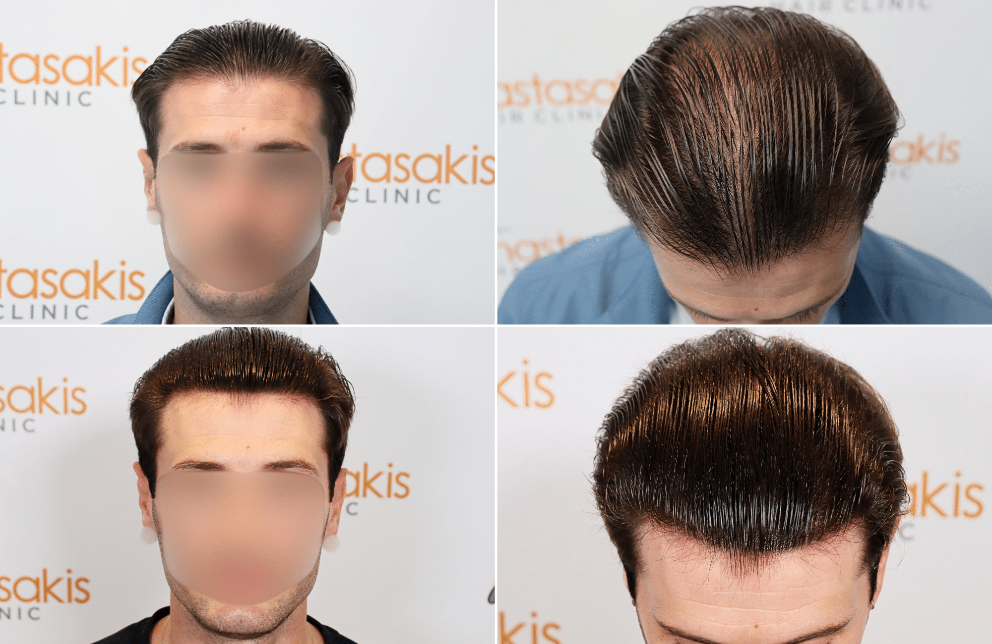 https://www.anastasakishairclinic.gr/portfolio/apotelesma-metamosxefsis-mallion-anastasakis-hair-clinic-187/