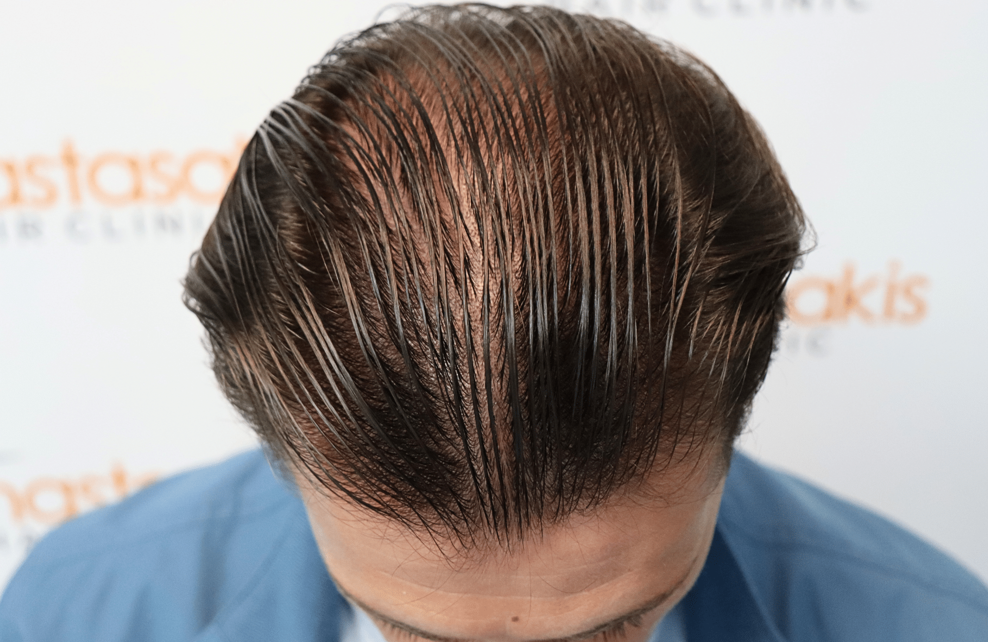 hair transplant result 1700 thickening