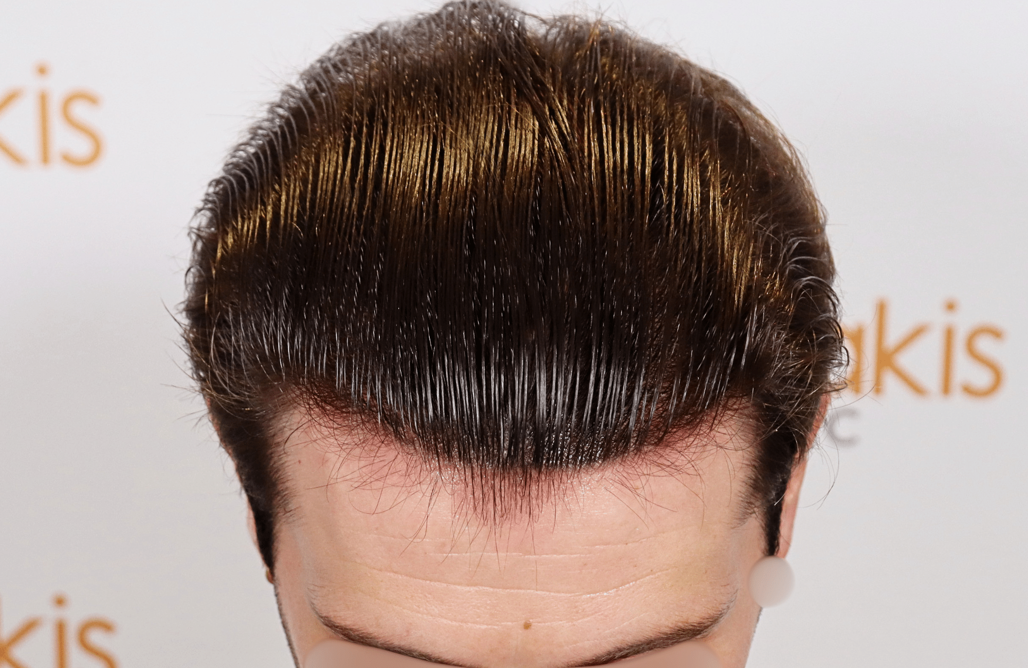 hair transplant result 1700 thickening