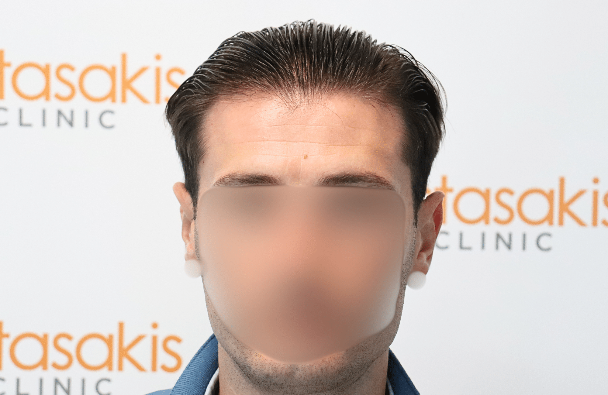 hair transplant result 1700 thickening