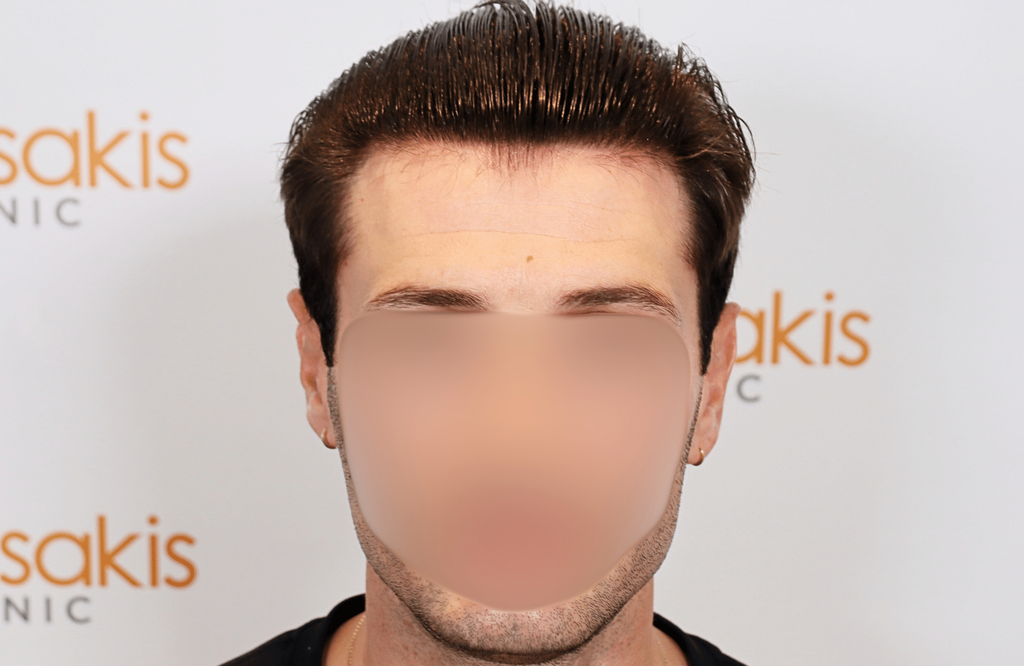 hair transplant result 1700 thickening