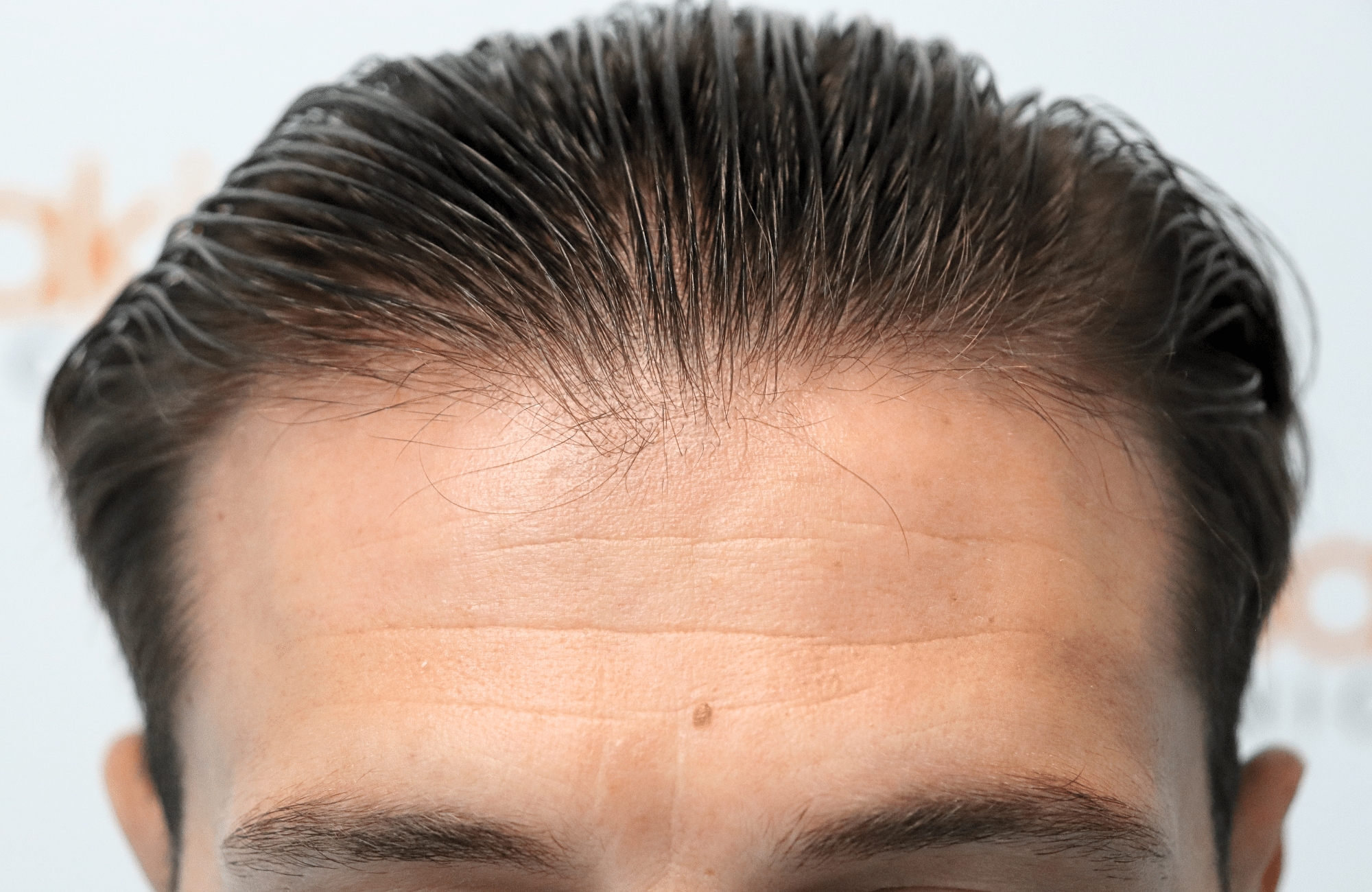 hair transplant result 1700 thickening