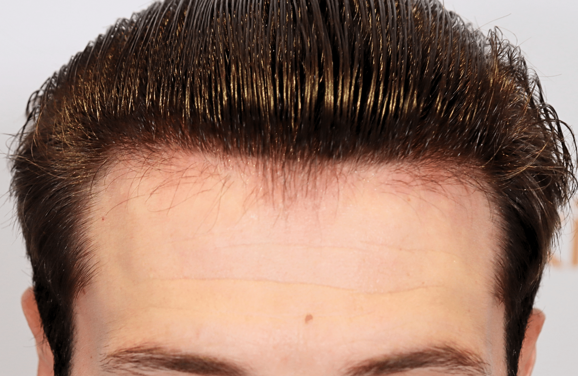 hair transplant result 1700 thickening
