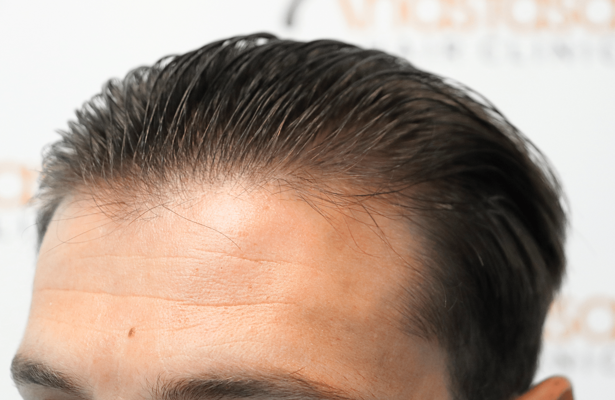 hair transplant result 1700 thickening