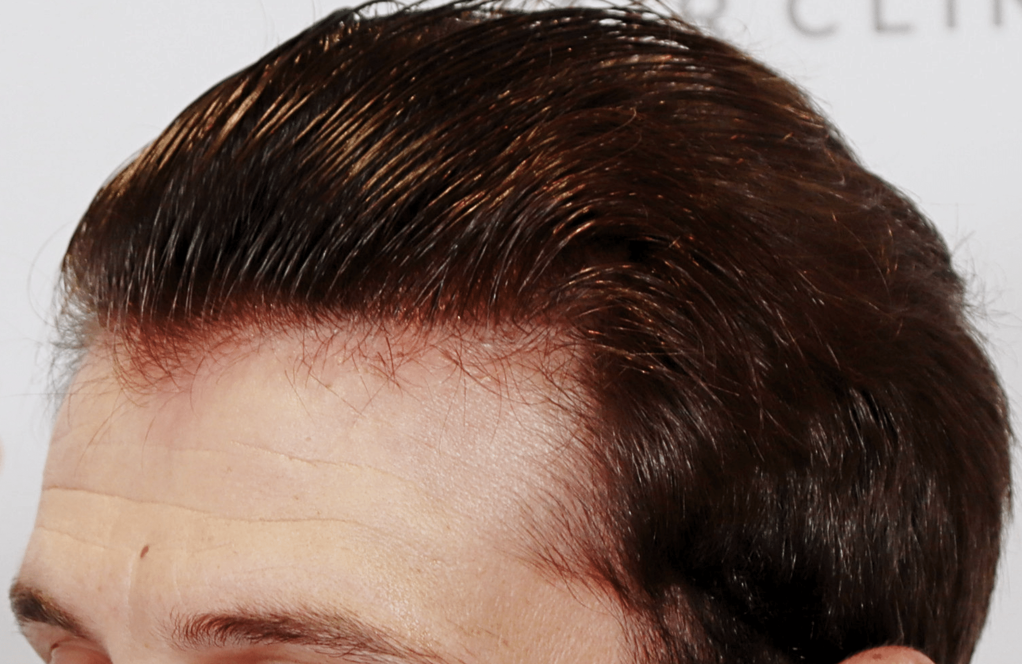 hair transplant result 1700 thickening