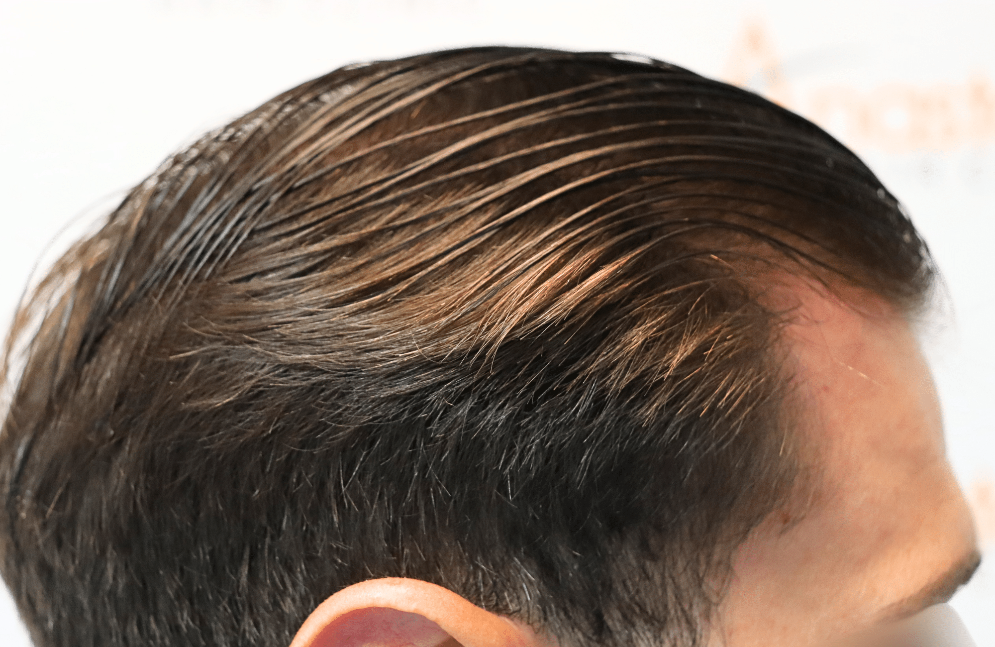 hair transplant result 1700 thickening