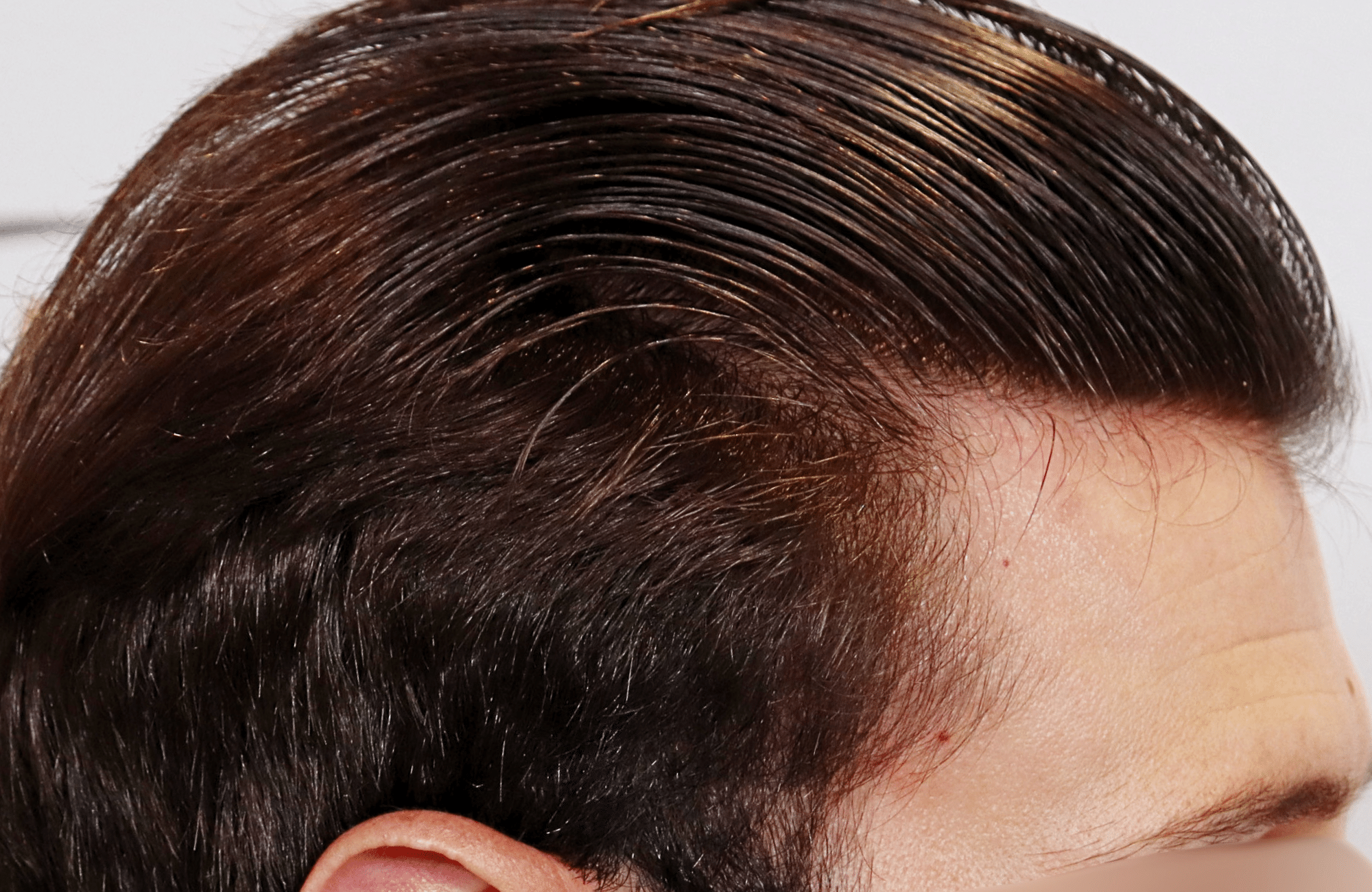 hair transplant result 1700 thickening