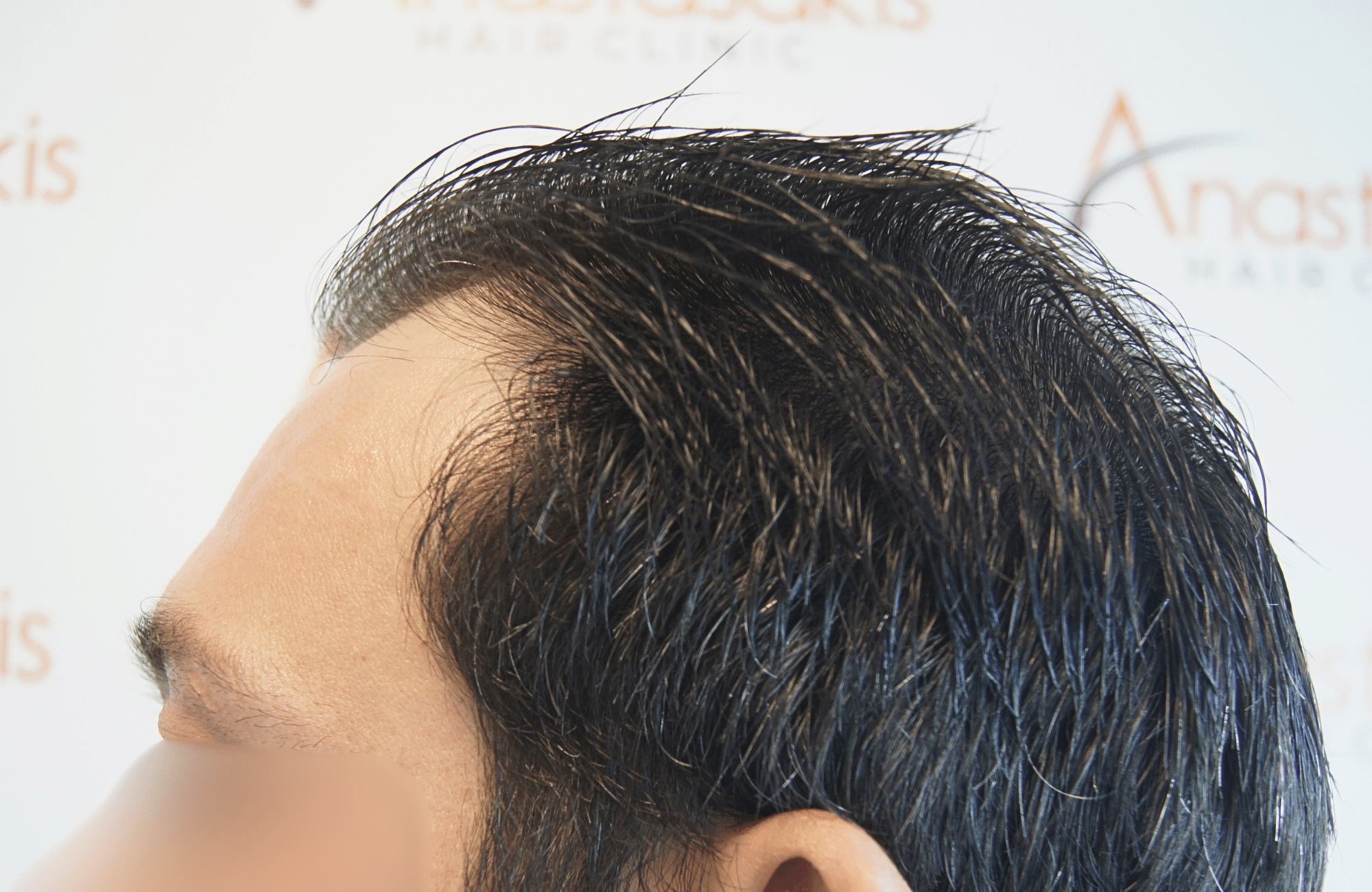 hair transplant result 1800 fus frontal thick
