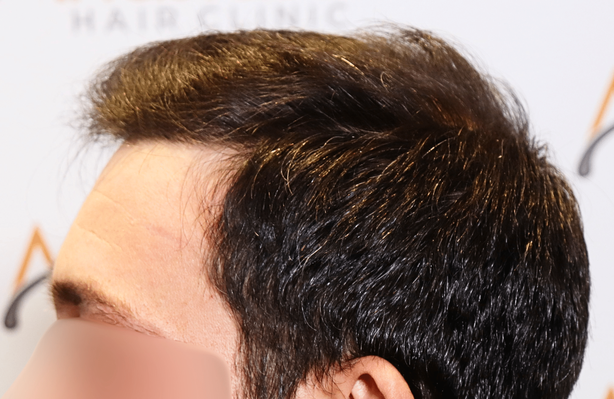 hair transplant result 1800 fus frontal thick