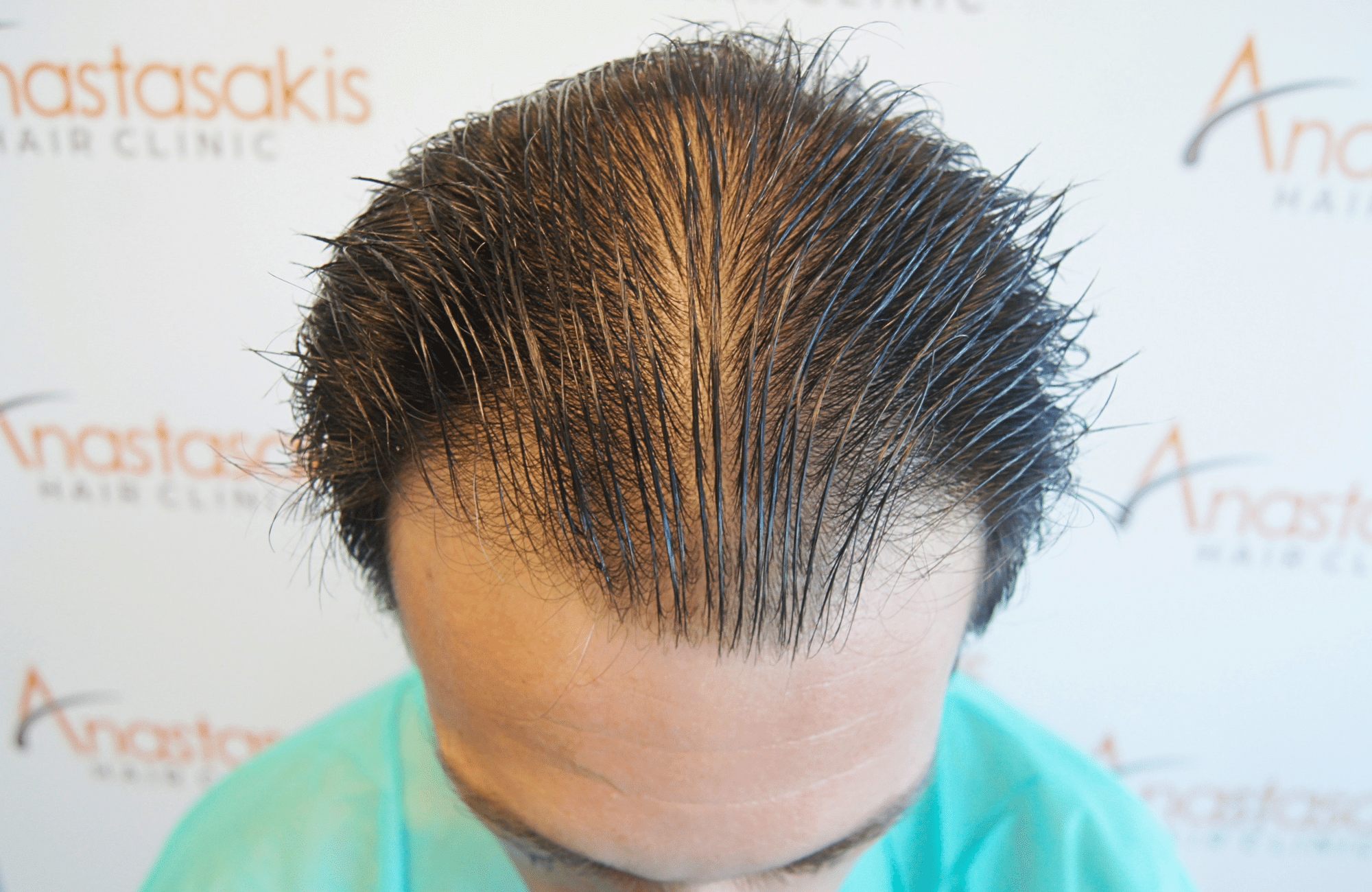 hair transplant result 1800 fus frontal thick