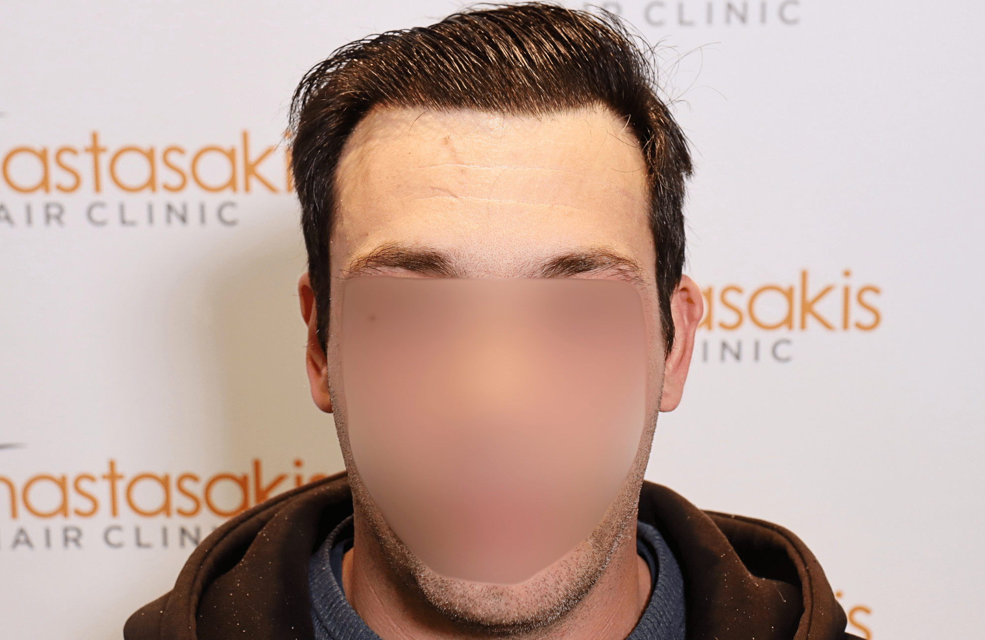 hair transplant result 1800 fus frontal thick