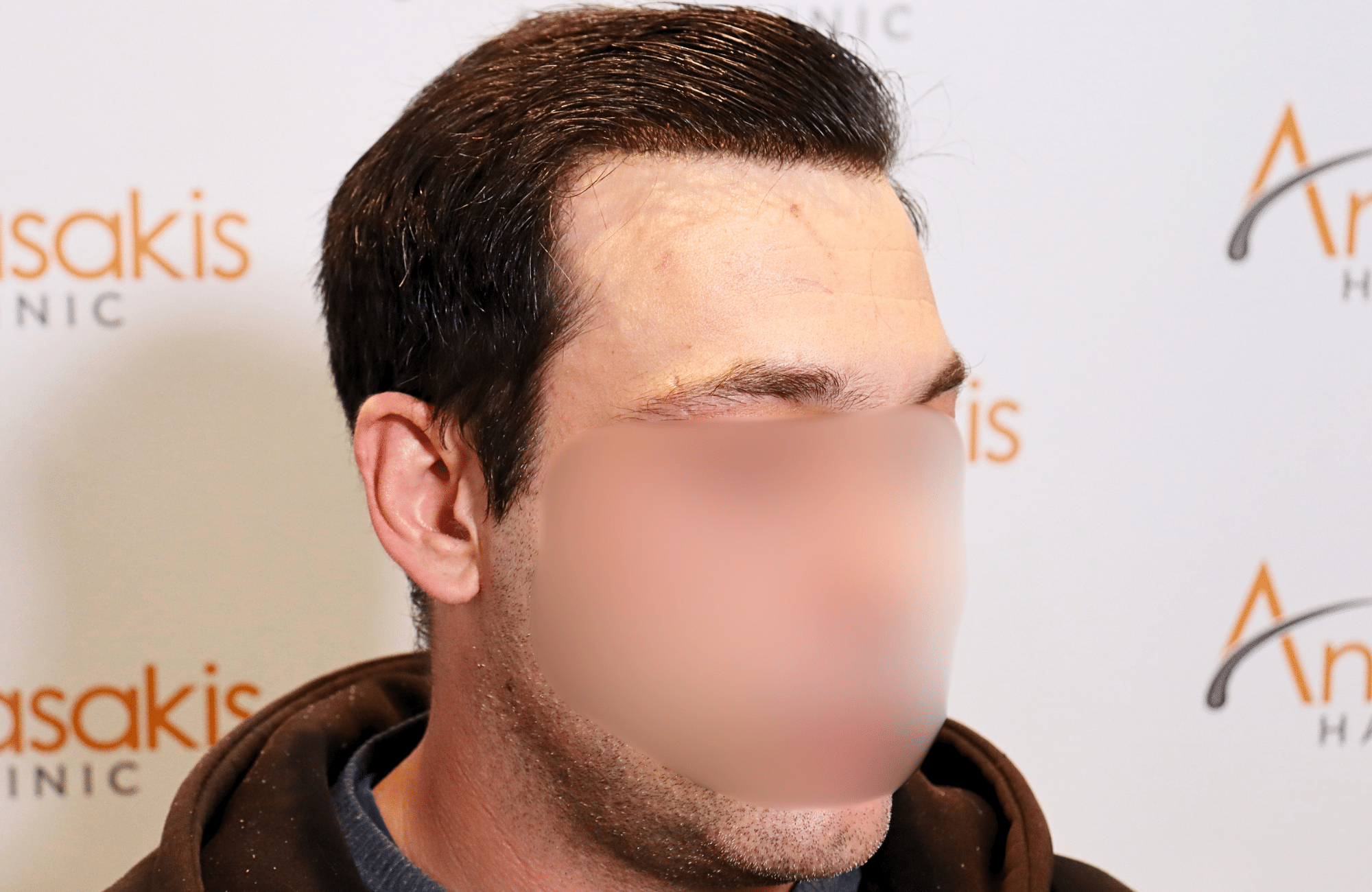 hair transplant result 1800 fus frontal thick